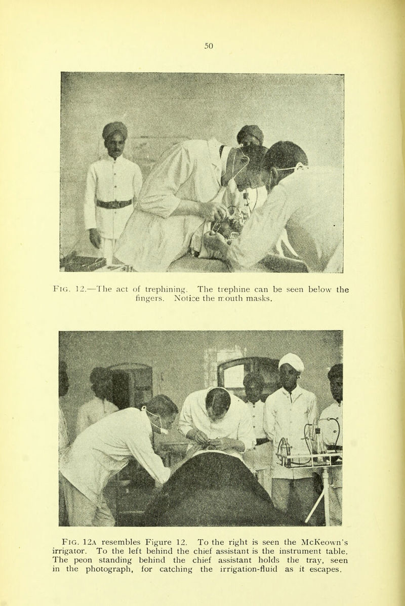 Fig. 12a resembles Figure 12. To the right is seen the McKeown's irrigator. To the left behind the chief assistant is the instrument table. The peon standing behind the chief assistant holds the tray, seen in the photograph, for catching the irrigation-fluid as it escapes.