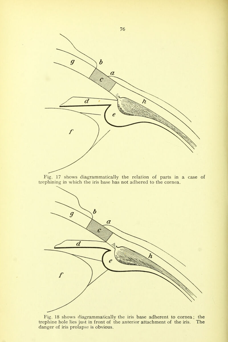 Fig. 17 shows diagrammatically the relation of parts in a case of trephining in which the iris base has not adhered to the cornea. Fig. 18 shows diagrammatically the iris base adherent to cornea; the trephine hole lies just in front of the anterior attachment of the iris. The danger of iris prolapse is obvious.