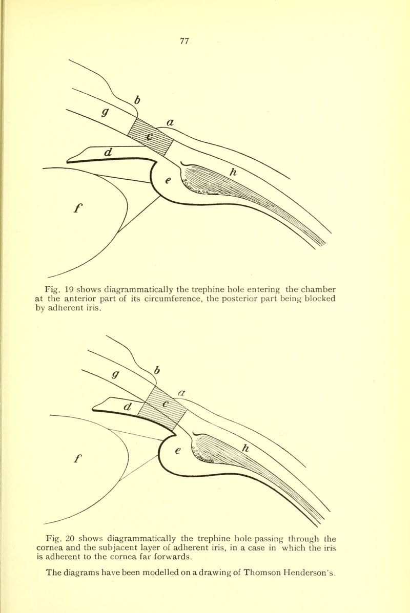 Fig. 19 shows diagrammatically the trephine hole entering the chamber at the anterior part of its circumference, the posterior part being blocked by adherent iris. Fig. 20 shows diagrammatically the trephine hole passing through the cornea and the subjacent layer of adherent iris, in a case in which the iris is adherent to the cornea far forwards. The diagrams have been modelled on a drawing of Thomson Henderson's.