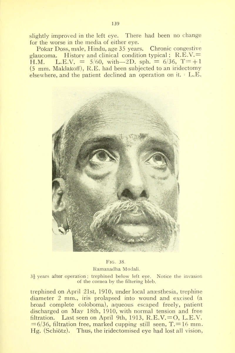 slightly improved in the left eye. There had been no change for the worse in the media of either eye. Pokar Doss, male, Hindu, age 35 years. Chronic congestive glaucoma. History and clinical condition typical; R.E.V.= H.M. L.E.V. = 5/60, with—2D. sph. = 6/36, T= + l (5 mm. Maklakoft'), R.E. had been subjected to an iridectomy elsewhere, and the patient declined an operation on it. • L.E, Fig. 38. Ramanadha Modali. 3^ years after operation; trephined below left eye. Notice the invasion of the cornea by the filtering bleb. trephined on April 21st, 1910, under local anaesthesia, trephine diameter 2 mm., iris prolapsed into wound and excised (a broad complete coloboma), aqueous escaped freely, patient discharged on May 18th, 1910, with normal tension and free filtration. Last seen on April 9th, 1913, R.E.V. = 0, L.E.V. = 6/36, filtration free, marked cupping still seen, T. = 16 mm. Hg. (Schiotz). Thus, the iridectomised eye had lost all vision,