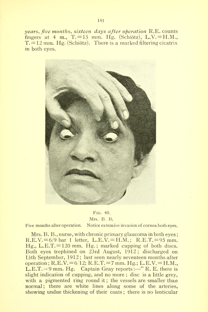 years, five months, sixteen days after operation R.E. counts fingers at 4 m., T. = 15 mm. Hg. (Schiotz), L.V. = H.M., T. = 12 mm. Hg. (Schiotz). There is a marked filtering cicatrix in both eyes. Fig. 40. Mrs. B. B. Five months after operation. Notice extensive invasion of cornea both eyes. Mrs. B. B., nurse, with chronic primary glaucoma in both eyes; R.E.V. = 6/9 bar 1 letter, L.E.V. = H.M.; R.E.T. = 95 mm. Hg., L.E.T. = 120 mm. Hg.; marked cupping of both discs. Both eyes trephined on 23rd August, 1912 ; discharged on 13th September, 1912 ; last seen nearly seventeen months after operation; R.E.V. = 6/12; R.E.T. = 7 mm. Hg.; L.E.V. = H.M., L.E.T. = 9 mm. Hg. Captain Gray reports:— R. E. there is slight indication of cupping, and no more ; disc is a little grey, with a pigmented ring round it; the vessels are smaller than normal; there are white lines along some of the arteries, showing undue thickening of their coats; there is no lenticular