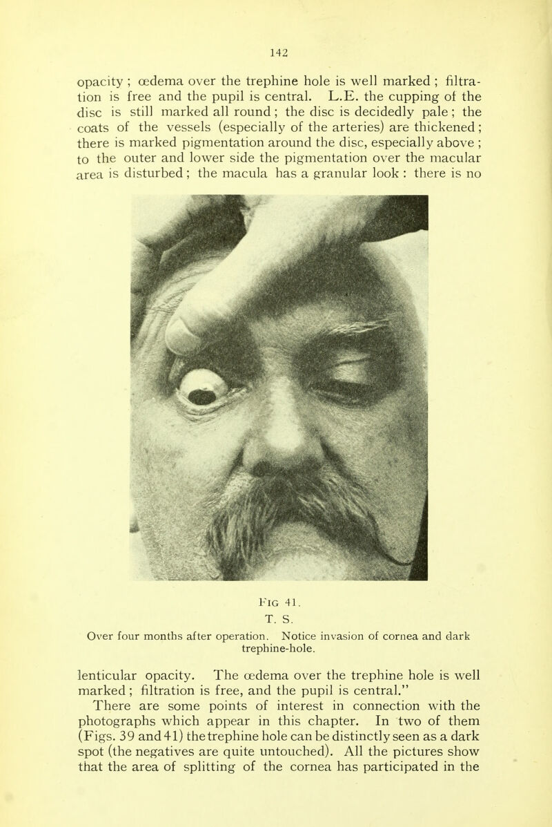 opacity ; oedema over the trephine hole is well marked ; filtra- tion is free and the pupil is central. L.E. the cupping of the disc is still marked all round; the disc is decidedly pale; the coats of the vessels (especially of the arteries) are thickened; there is marked pigmentation around the disc, especially above ; to the outer and lower side the pigmentation over the macular area is disturbed; the macula has a granular look : there is no Fig 41. T. S. Over four months after operation. Notice invasion of cornea and dark trephine-hole. lenticular opacity. The oedema over the trephine hole is well marked; filtration is free, and the pupil is central. There are some points of interest in connection with the photographs which appear in this chapter. In two of them (Figs. 39 and 41) the trephine hole can be distinctly seen as a dark spot (the negatives are quite untouched). All the pictures show that the area of splitting of the cornea has participated in the