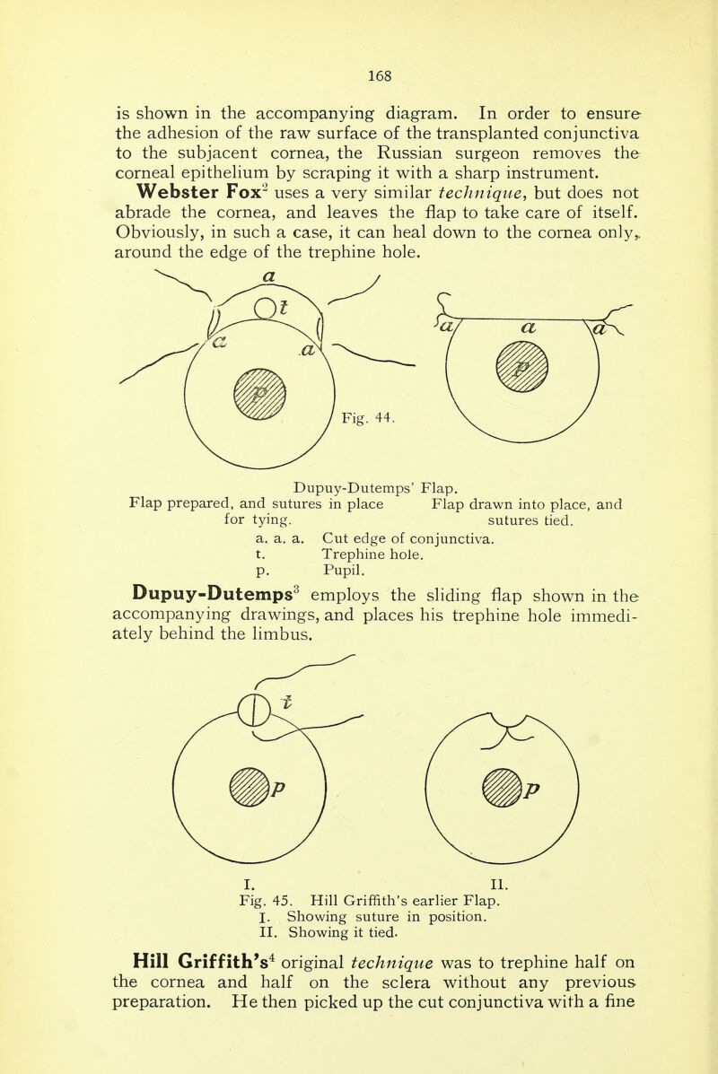 is shown in the accompanying diagram. In order to ensure the adhesion of the raw surface of the transplanted conjunctiva to the subjacent cornea, the Russian surgeon removes the corneal epithelium by scraping it with a sharp instrument. Webster Fox'^ uses a very similar technique, but does not abrade the cornea, and leaves the flap to take care of itself. Obviously, in such a case, it can heal down to the cornea only,, around the edge of the trephine hole. Dupuy-Dutemps' Flap. Flap prepared, and sutures in place Flap drawn into place, and for tying. sutures tied, a. a. a. Cut edge of conjunctiva, t. Trephine hole, p. Pupil. Dupuy-Dutemps^ employs the sliding flap shown in the accompanying drawings, and places his trephine hole immedi- ately behind the limbus. I. II. Fig. 45. Hill Griffith's earlier Flap. I. Showing suture in position. II. Showing it tied. Hill Griffith's* original technique was to trephine half on the cornea and half on the sclera without any previous preparation. He then picked up the cut conjunctiva with a fine