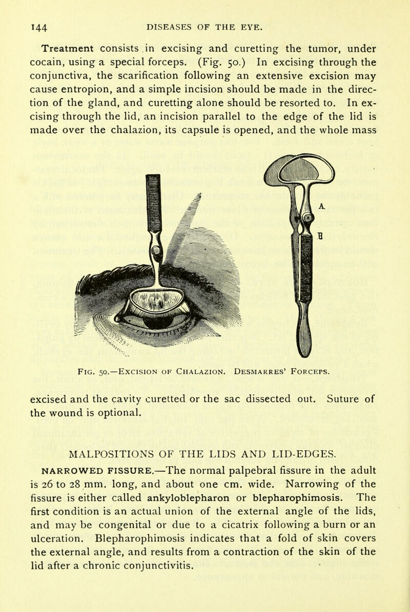 Treatment consists in excising and curetting the tumor, under cocain, using a special forceps. (Fig. 50.) In excising through the conjunctiva, the scarification following an extensive excision may cause entropion, and a simple incision should be made in the direc- tion of the gland, and curetting alone should be resorted to. In ex- cising through the lid, an incision parallel to the edge of the lid is made over the chalazion, its capsule is opened, and the whole mass Fig. 50.—Excision of Chalazion. Desmarres' Forceps. excised and the cavity curetted or the sac dissected out. Suture of the wound is optional. MALPOSITIONS OF THE LIDS AND LID-EDGES. narrowed FISSURE.—The normal palpebral fissure in the adult is 26 to 28 mm. long, and about one cm. wide. Narrowing of the fissure is either called ankyloblepharon or blepharophimosis. The first condition is an actual union of the external angle of the lids, and may be congenital or due to a cicatrix following a burn or an ulceration. Blepharophimosis indicates that a fold of skin covers the external angle, and results from a contraction of the skin of the lid after a chronic conjunctivitis.