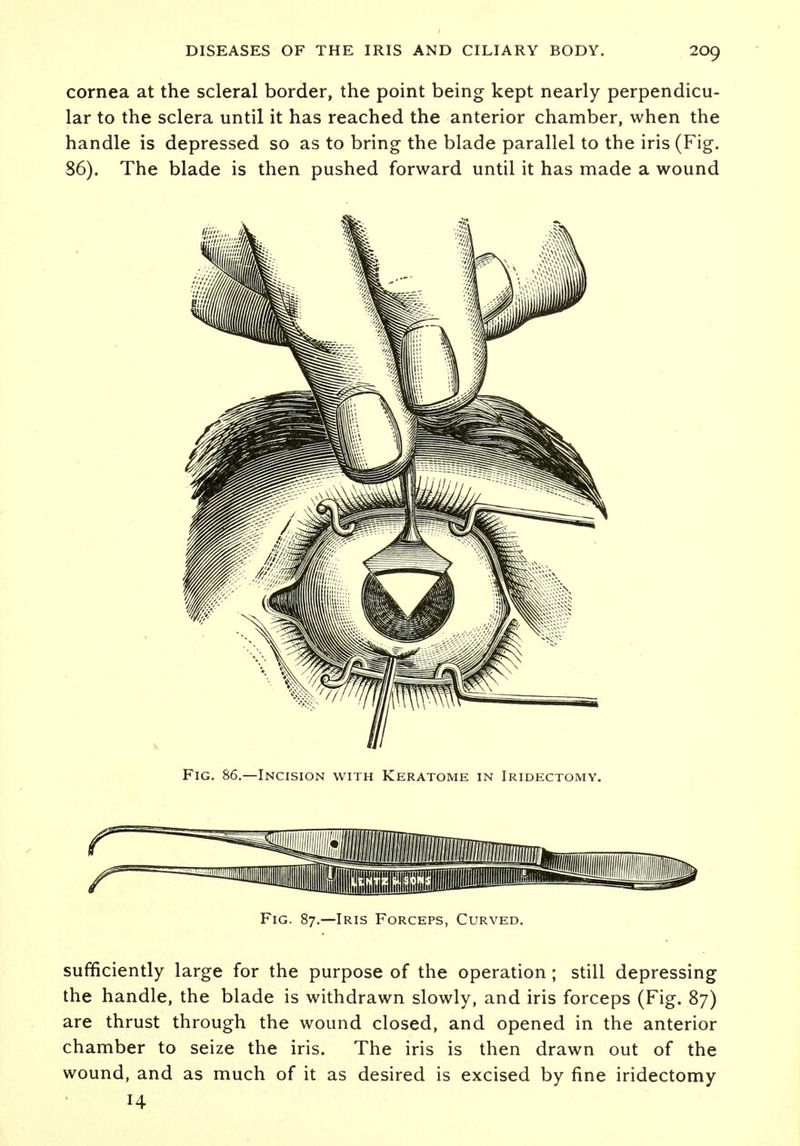 cornea at the scleral border, the point being kept nearly perpendicu- lar to the sclera until it has reached the anterior chamber, when the handle is depressed so as to bring the blade parallel to the iris (Fig. 86). The blade is then pushed forward until it has made a wound Fig. 86.—Incision with Keratome in Iridectomy. Fig. 87.—Iris Forceps, Curved sufficiently large for the purpose of the operation; still depressing the handle, the blade is withdrawn slowly, and iris forceps (Fig. 87) are thrust through the wound closed, and opened in the anterior chamber to seize the iris. The iris is then drawn out of the wound, and as much of it as desired is excised by fine iridectomy