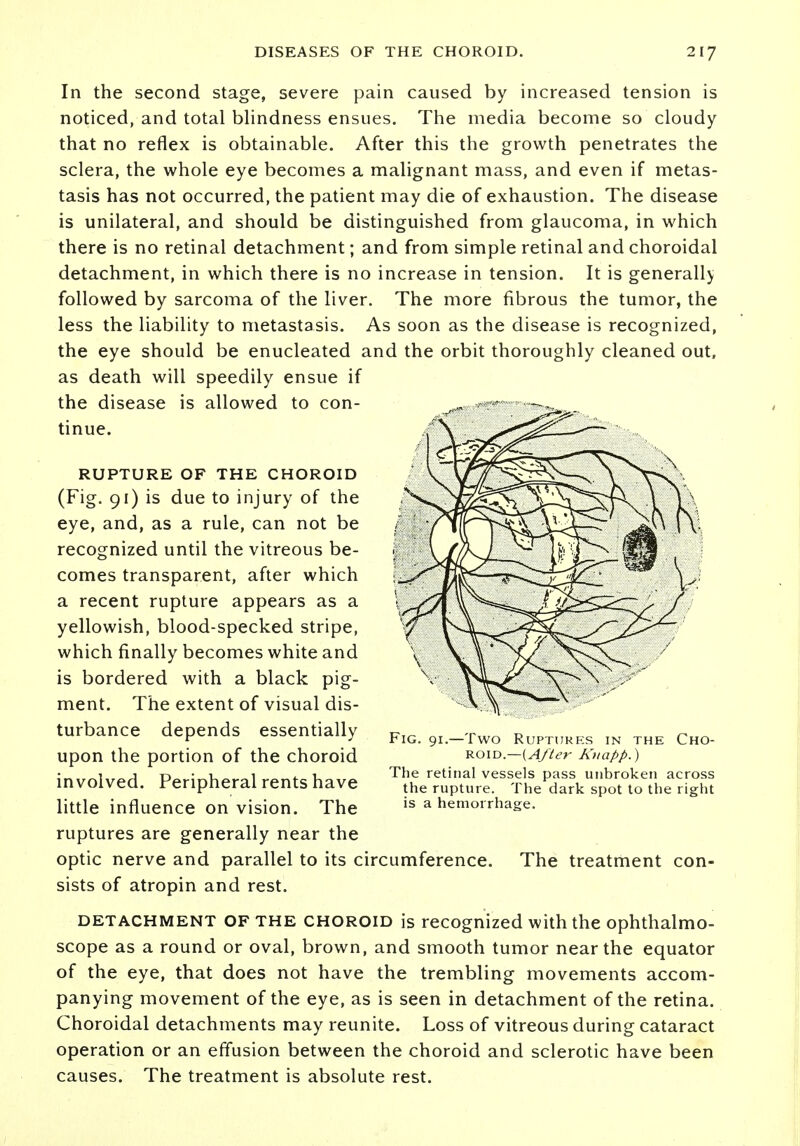 In the second stage, severe pain caused by increased tension is noticed, and total blindness ensues. The media become so cloudy that no reflex is obtainable. After this the growth penetrates the sclera, the whole eye becomes a malignant mass, and even if metas- tasis has not occurred, the patient may die of exhaustion. The disease is unilateral, and should be distinguished from glaucoma, in which there is no retinal detachment; and from simple retinal and choroidal detachment, in which there is no increase in tension. It is generally followed by sarcoma of the liver. The more fibrous the tumor, the less the liability to metastasis. As soon as the disease is recognized, the eye should be enucleated and the orbit thoroughly cleaned out, as death will speedily ensue if the disease is allowed to con- tinue. RUPTURE OF THE CHOROID (Fig. 91) is due to injury of the eye, and, as a rule, can not be recognized until the vitreous be- comes transparent, after which a recent rupture appears as a yellowish, blood-specked stripe, which finally becomes white and is bordered with a black pig- ment. The extent of visual dis- turbance depends essentially upon the portion of the choroid involved. Peripheral rents have little influence on vision. The ruptures are generally near the optic nerve and parallel to its circumference. The treatment con- sists of atropin and rest. detachment OF the choroid is recognized with the ophthalmo- scope as a round or oval, brown, and smooth tumor near the equator of the eye, that does not have the trembling movements accom- panying movement of the eye, as is seen in detachment of the retina. Choroidal detachments may reunite. Loss of vitreous during cataract operation or an effusion between the choroid and sclerotic have been causes. The treatment is absolute rest. Fig. 91.—Two Ruptures in the Cho- roid.— (After Kuapp.) The retinal vessels pass unbroken across the rupture. The dark spot to the right is a hemorrhage.