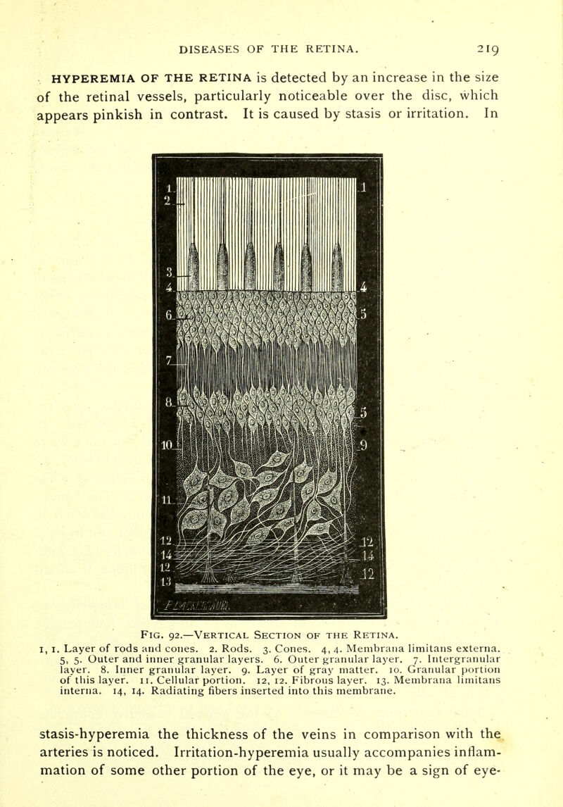 hyperemia OF the retina is detected by an increase in the size of the retinal vessels, particularly noticeable over the disc, which appears pinkish in contrast. It is caused by stasis or irritation. In Fig. 92.—Vertical Section of the Retina. 1, 1. Layer of rods and cones. 2. Rods. 3. Cones. 4, 4. Membrana limitans externa. 5, 5. Outer and inner granular layers. 6. Outer granular layer. 7. Intergranular layer. 8. Inner granular layer. 9. Layer of gray matter. 10. Granular portion of this layer. 11. Cellular portion. 12, 12. Fibrous layer. 13. Membrana limitans interna. 14, 14. Radiating fibers inserted into this membrane. stasis-hyperemia the thickness of the veins in comparison with the arteries is noticed. Irritation-hyperemia usually accompanies inflam- mation of some other portion of the eye, or it may be a sign of eye-