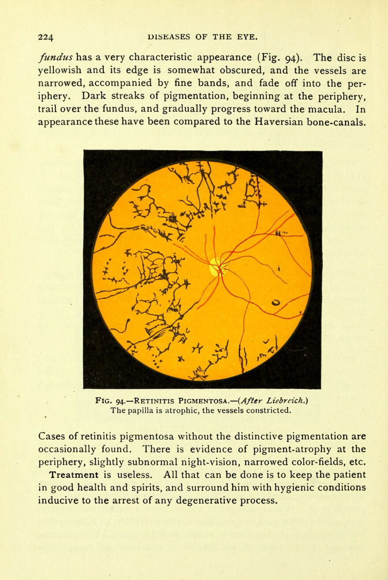 fundus has a very characteristic appearance (Fig. 94). The disc is yellowish and its edge is somewhat obscured, and the vessels are narrowed, accompanied by fine bands, and fade off into the per- iphery. Dark streaks of pigmentation, beginning at the periphery, trail over the fundus, and gradually progress toward the macula. In appearance these have been compared to the Haversian bone-canals. Fig. 94.—Retinitis Pigmentosa.—{After Liebreich.) The papilla is atrophic, the vessels constricted. * Cases of retinitis pigmentosa without the distinctive pigmentation are occasionally found. There is evidence of pigment-atrophy at the periphery, slightly subnormal night-vision, narrowed color-fields, etc. Treatment is useless. All that can be done is to keep the patient in good health and spirits, and surround him with hygienic conditions inducive to the arrest of any degenerative process.