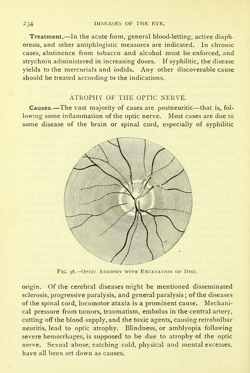 . Treatment.—In the acute form, general blood-letting, active diaph- oresis, and other antiphlogistic measures are indicated. In chronic cases, abstinence from tobacco and alcohol must be enforced, and strychnin administered in increasing doses. If syphilitic, the disease yields to the mercurials and iodids. Any other discoverable cause should be treated according to the indications. ATROPHY OF THE OPTIC NERVE. Causes.—The vast majority of cases are postneuritic—that is, fol- lowing some inflammation of the optic nerve. Most cases are due to some disease of the brain or spinal cord, especially of syphilitic Fig. 98.—Optic Atrophy with Excavation of Disc. origin. Of the cerebral diseases might be mentioned disseminated sclerosis, progressive paralysis, and general paralysis ; of the diseases of the spinal cord, locomotor ataxia is a prominent cause. Mechani- cal pressure from tumors, traumatism, embolus in the central artery, cutting off the blood-supply, and the toxic agents, causing retrobulbar neuritis, lead to optic atrophy. Blindness, or amblyopia following severe hemorrhages, is supposed to be due to atrophy of the optic nerve. Sexual abuse, catching cold, physical and mental excesses, have all been set down as causes.