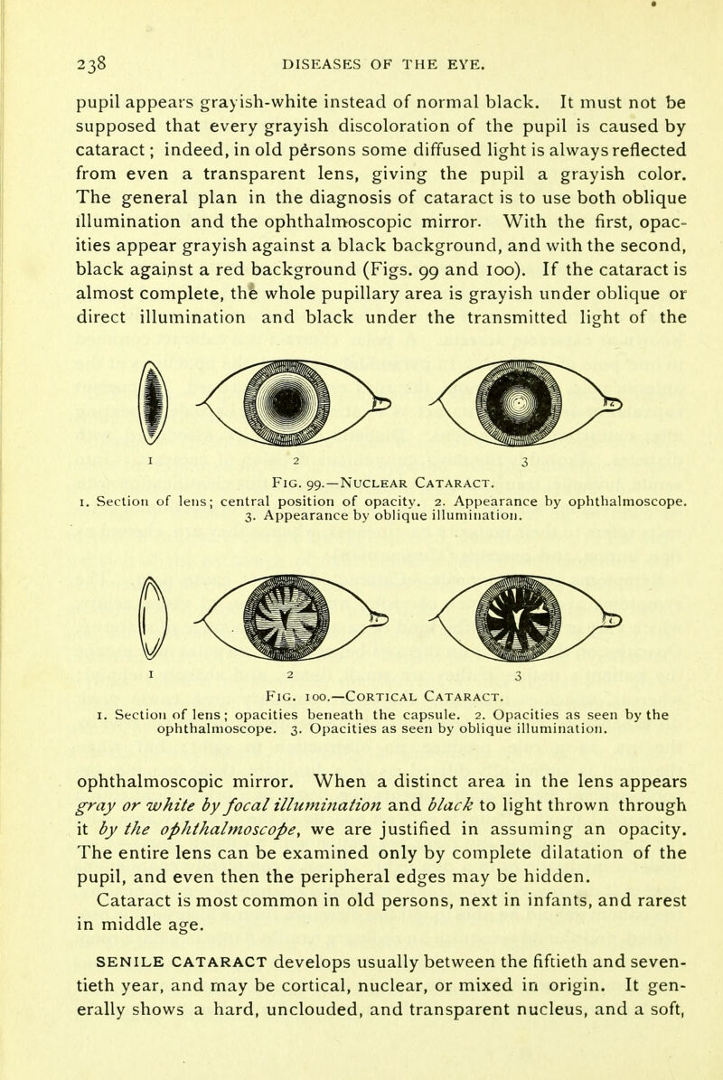 pupil appears grayish-white instead of normal black. It must not be supposed that every grayish discoloration of the pupil is caused by cataract; indeed, in old persons some diffused light is always reflected from even a transparent lens, giving the pupil a grayish color. The general plan in the diagnosis of cataract is to use both oblique illumination and the ophthalmoscopic mirror. With the first, opac- ities appear grayish against a black background, and with the second, black against a red background (Figs. 99 and 100). If the cataract is almost complete, the whole pupillary area is grayish under oblique or direct illumination and black under the transmitted light of the Fig. 99.—Nuclear Cataract. 1. Section of lens; central position of opacity. 2. Appearance by ophthalmoscope. 3. Appearance by oblique illumination. Fig. 100.—Cortical Cataract. 1. Section of lens; opacities beneath the capsule. 2. Opacities as seen by the ophthalmoscope. 3. Opacities as seen by oblique illumination. ophthalmoscopic mirror. When a distinct area in the lens appears gray or white by focal illumination and black to light thrown through it by the ophthalmoscope, we are justified in assuming an opacity. The entire lens can be examined only by complete dilatation of the pupil, and even then the peripheral edges may be hidden. Cataract is most common in old persons, next in infants, and rarest in middle age. senile CATARACT develops usually between the fiftieth and seven- tieth year, and may be cortical, nuclear, or mixed in origin. It gen- erally shows a hard, unclouded, and transparent nucleus, and a soft, 1 2 3