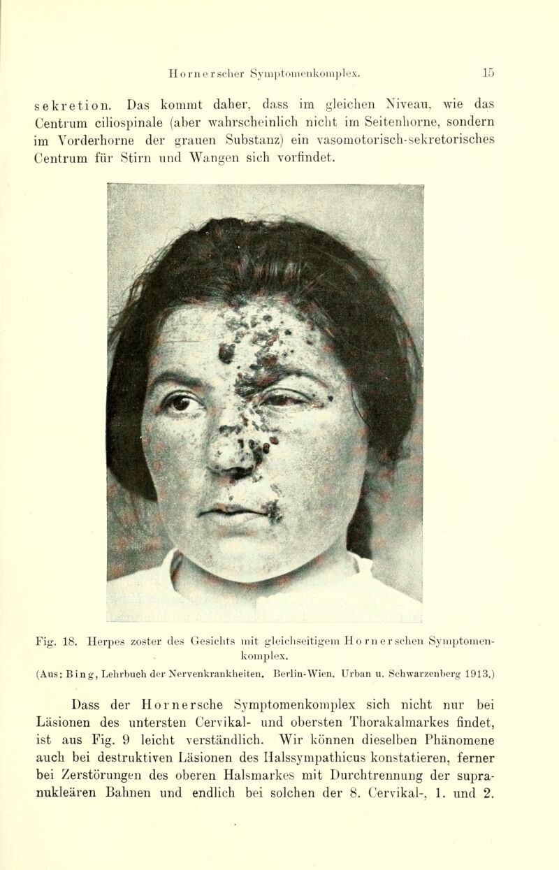 Horner scher Symptomenkomplex. Sekretion. Das kommt daher, dass im gleichen Niveau, wie das Centrum ciliospinale (aber wahrscheinlich nicht im Seitenhorne, sondern im Vorderhorne der grauen Substanz) ein vasomotorisch-sekretorisches Centrum für Stirn und Wangen sich vorfindet. Fig. 18. Herpes zoster des Gesichts mit gleichseitigem Horn er sehen Symptomen- komplex. (Aus: Bing, Lehrbuch der Nervenkrankheiten. Berlin-Wien, Urban u. Sehwarzenberg 1913.) Dass der Hornersche Symptomenkomplex sich nicht nur bei Läsionen des untersten Cervikal- und obersten Thorakalmarkes findet, ist aus Fig. 9 leicht verständlich. Wir können dieselben Phänomene auch bei destruktiven Läsionen des Halssympathicus konstatieren, ferner bei Zerstörungen des oberen Halsmarkes mit Durchtrennung der supra-