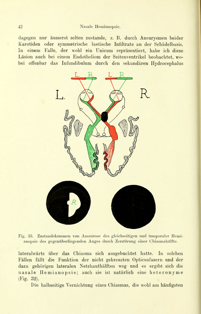 dagegen nur äusserst selten zustande, z. B. durch Aneurysmen beider Karotiden oder symmetrische luetische Infiltrate an der Schädelbasis. In einem Falle, der wohl ein Unicum repräsentiert, habe ich diese Läsion auch bei einem Endotheliom der Seitenventrikel beobachtet, wo- bei olfenbar das Infundibulum durch den sekundären Hydrocephalus Fig. 33. Zustandekommen von Amaurose des gleichseitigen und temporaler Hemi- anopsie des gegenüberliegenden Auges durch Zerstörung einer Chiasmahälfte. lateralwärts über das Chiasma sich ausgebuchtet hatte. In solchen Fällen fällt die Funktion der nicht gekreuzten Opticusfasern und der dazu gehörigen lateralen Netzhauthälften weg und es ergibt sich die nasale Hemianopsie; auch sie ist natürlich eine heteronyme (Fig. 32). . » Die halbseitige Vernichtung eines Chiasmas, die wohl am häufigsten