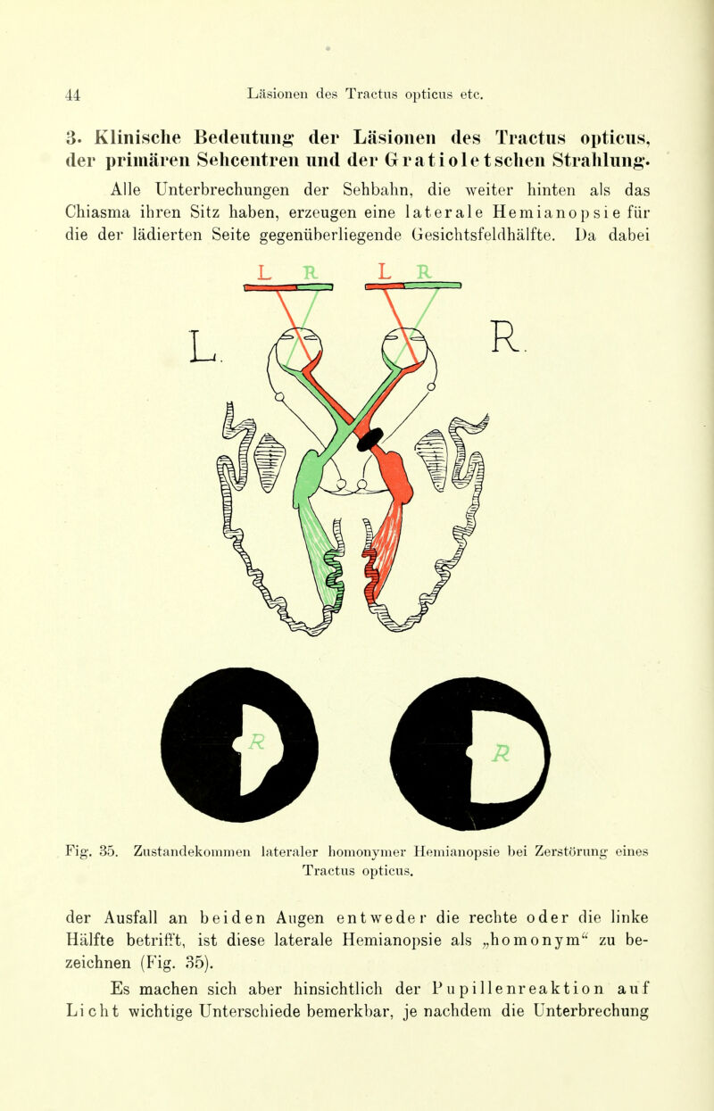 3. Klinische Bedeutung der Läsionen des Tractus opticus, der primären Sehcentren und der Gratiole tsehen Strahlung. Alle Unterbrechungen der Sehbahn, die weiter hinten als das Chiasma ihren Sitz haben, erzeugen eine laterale Hemianop si e für die der lädierten Seite gegenüberliegende Gesichtsfeldhälfte. Da dabei Fig. 35. Zustandekommen lateraler homonymer Hemianopsie bei Zerstörung eines Tractus opticus. der Ausfall an beiden Augen entweder die rechte oder die linke Hälfte betrifft, ist diese laterale Hemianopsie als „homonym zu be- zeichnen (Fig. 35). Es machen sich aber hinsichtlich der Pupillenreaktion auf Licht wichtige Unterschiede bemerkbar, je nachdem die Unterbrechung