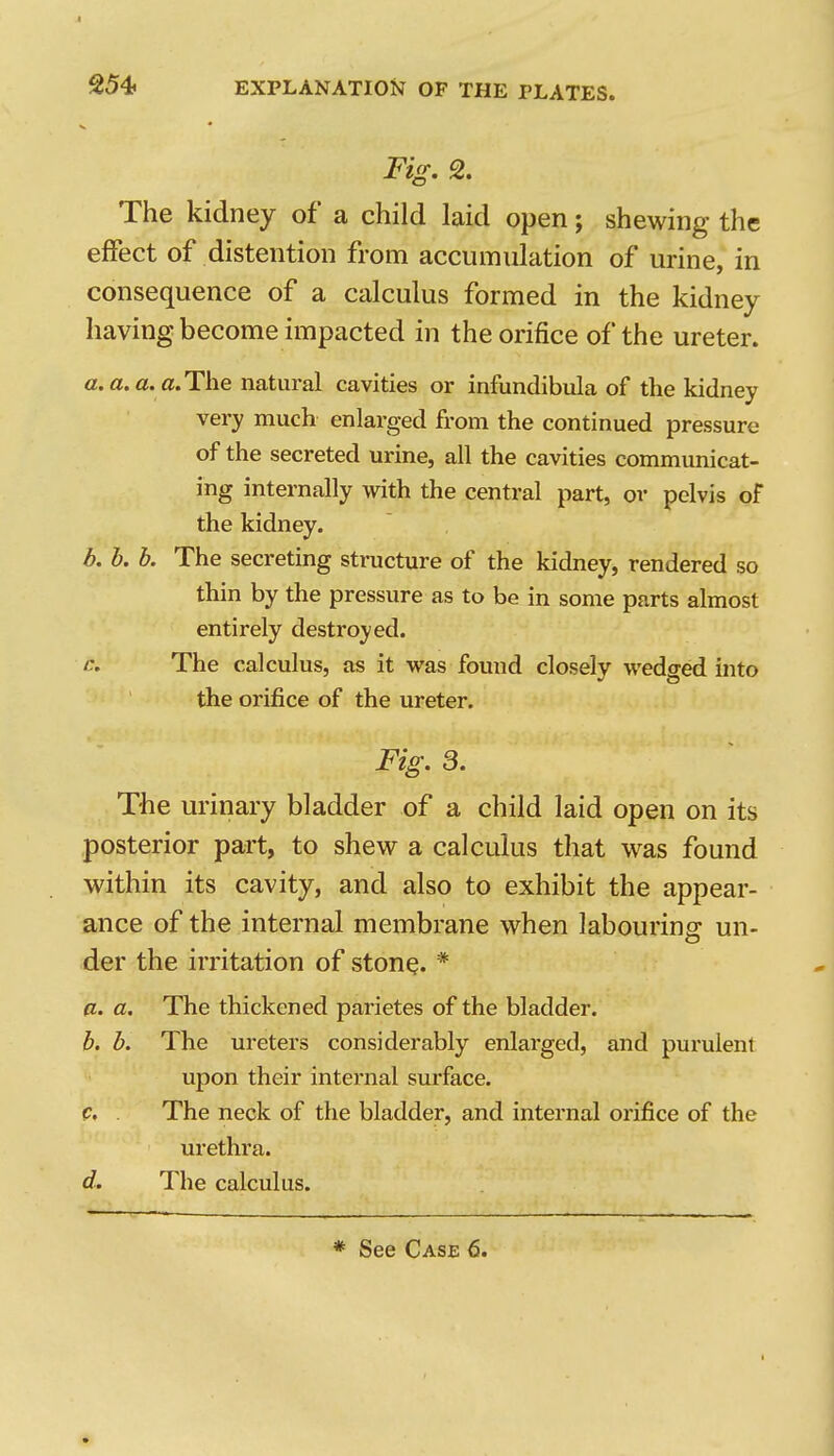 Fig. 2. The kidney of a child laid open; shewing the effect of distention from accumulation of urine, in consequence of a calculus formed in the kidney having become impacted in the orifice of the ureter. a. a. a. fl. The natural cavities or infundibula of the kidney very much enlarged from the continued pressure of the secreted urine, all the cavities communicat- ing internally with the central part, or pelvis of the kidney. b. h. b. The secreting structure of the kidney, rendered so thin by the pressure as to be in some parts almost entirely destroyed. r. The calculus, as it was found closely wedged into the orifice of the ureter. Fig. S. The urinary bladder of a child laid open on its posterior part, to shew a calculus that was found within its cavity, and also to exhibit the appear- ance of the internal membrane when labouring un- der the irritation of stone. * a. a. The thickened parietes of the bladder, b. b. The ureters considerably enlarged, and purulent upon their internal surface, p. . The neck of the bladder, and internal orifice of the urethra. d. The calculus.
