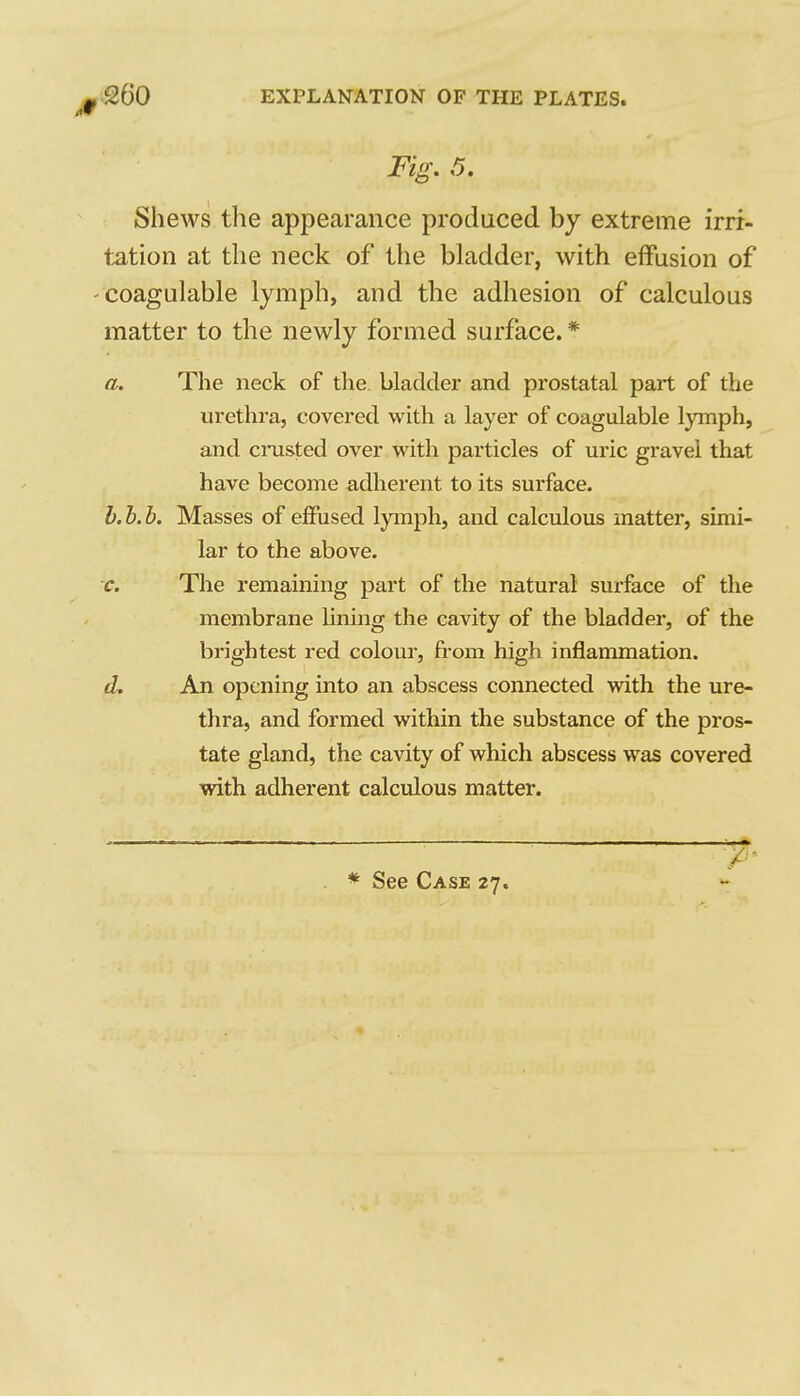 Fig. 5, Shews the appearance produced by extreme irri- tation at the neck of the bladder, with effusion of coagulable lymph, and the adhesion of calculous matter to the newly formed surface. * a. The neck of the. bladder and prostatal part of the urethra, covered with a layer of coagulable lymph, and crusted over with particles of uric gravel that have become adherent to its surface. b. b.b. Masses of effused lymph, and calculous matter, simi- lar to the above. c. The remaining part of the natural surface of the membrane lining the cavity of the bladder, of the brightest red colour, from high inflammation. d. An opening into an abscess connected with the ure- thra, and formed within the substance of the pros- tate gland, the cavity of which abscess was covered with adherent calculous matter. * See Case 27.