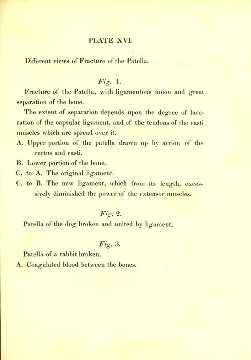 Different views of Fracture of the Patella. Fig. 1. Fracture of the Patella, with ligamentous union and great separation of the bone. The extent of separation depends upon the degree of lace- ration of the capsular ligament, and of the tendons of the vasti muscles which are spread over it. A. Upper portion of the patella drawn up by action of the rectus and vasti. B. Lower portion of the bone. C. to A. The original ligament. C. to B. The new ligament, which from its length, exces- sively diminished the power of the extensor muscles. Fig. 2. Patella of the dog broken and united by ligament. Fig. 3. Patella of a rabbit broken. A. Coagulated blood between the bones.