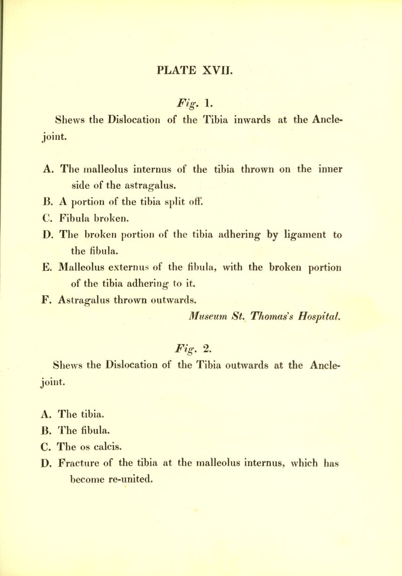 Fig. 1. Shews the Dislocation of the Tibia inwards at the Ancle- joint. A. The malleolus interims of the tibia thrown on the inner side of the astragalus. B. A portion of the tibia split off. C. Fibula broken. D. The broken portion of the tibia adhering by ligament to the fibula. E. Malleolus externus of the fibula, with the broken portion of the tibia adhering to it. F. Astragalus thrown outwards. Museum St. Thomas's Hospital. Fig. 2. Shews the Dislocation of the Tibia outwards at the Ancle- joint. A. The tibia. B. The fibula. C. The os calcis. D. Fracture of the tibia at the malleolus internus, which has become re-united.