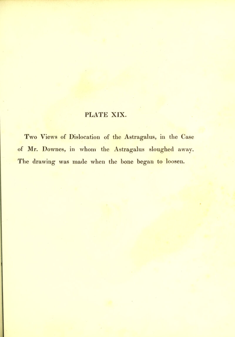PLATE XIX. Two Views of Dislocation of the Astragalus, in the Case of Mr. Downes, in whom the Astragalus sloughed away. The drawing was made when the bone began to loosen.