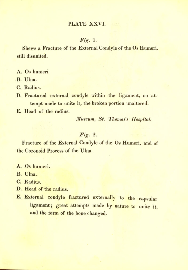 Fig. 1. Shews a Fracture of the External Condyle of the Os Humeri, still disunited. A. Os humeri. B. Ulna. C. Radius. D. Fractured external condyle within the ligament, no at- tempt made to unite it, the broken portion unaltered. E. Head of the radius. Museum, St. Thomas s Hospital. Fig. 2. Fracture of the External Condyle of the Os Humeri, and of the Coronoid Process of the Ulna. A. Os humeri. B. Ulna. C. Radius. D. Head of the radius. E. External condyle fractured externally to the capsular ligament; great attempts made by nature to unite it, and the form of the bone changed.