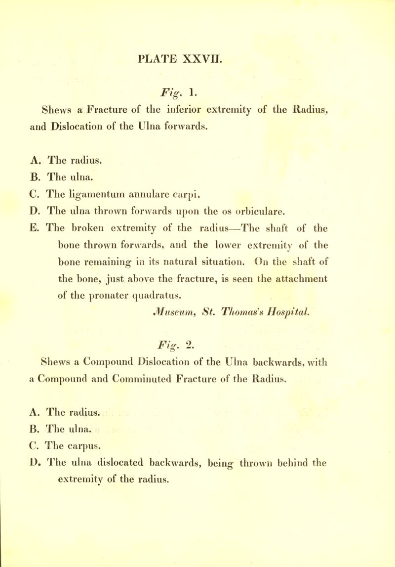 Fig. 1. Shews a Fracture of the inferior extremity of the Radius, and Dislocation of the Ulna forwards. A. The radius. B. The ulna. C. The lig'amentum annulare carpi, D. The ulna thrown forwards upon the os orbiculare. E. The broken extremity of the radius—The shaft of the bone thrown forwards, and the lower extremity of the bone remaining in its natural situation. On the shaft of the bone, just above the fracture, is seen the attachment of the pronater quadratus. Museum, St. Thomas's Hospital. Fig. 2. Shews a Compound Dislocation of the Ulna backwards, with a Compound and Comminuted Fracture of the Radius. A. The radius. B. The ulna. C. The carpus. D. The ulna dislocated backwards, being thrown behind the extremity of the radius.