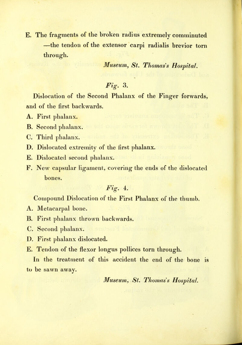 E. The fragments of the broken radius extremely comminuted —the tendon of the extensor carpi radialis brevior torn through. Museum, St. Thomas's Hospital. Fig. 3. Dislocation of the Second Phalanx of the Finger forwards, and of the first backwards. A. First phalanx. B. Second phalanx. C. Third phalanx. D. Dislocated extremity of the first phalanx. E. Dislocated second phalanx. F. New capsular ligament, covering the ends of the dislocated bones. Fig. 4. Compound Dislocation of the First Phalanx of the thumb. A. Metacarpal bone. B. First phalanx thrown backwards. C. Second phalanx. D. First phalanx dislocated. E. Tendon of the flexor longus pollices torn through. In the treatment of this accident the end of the bone is to be sawn away. Museum, St. Thomas s Hospital.