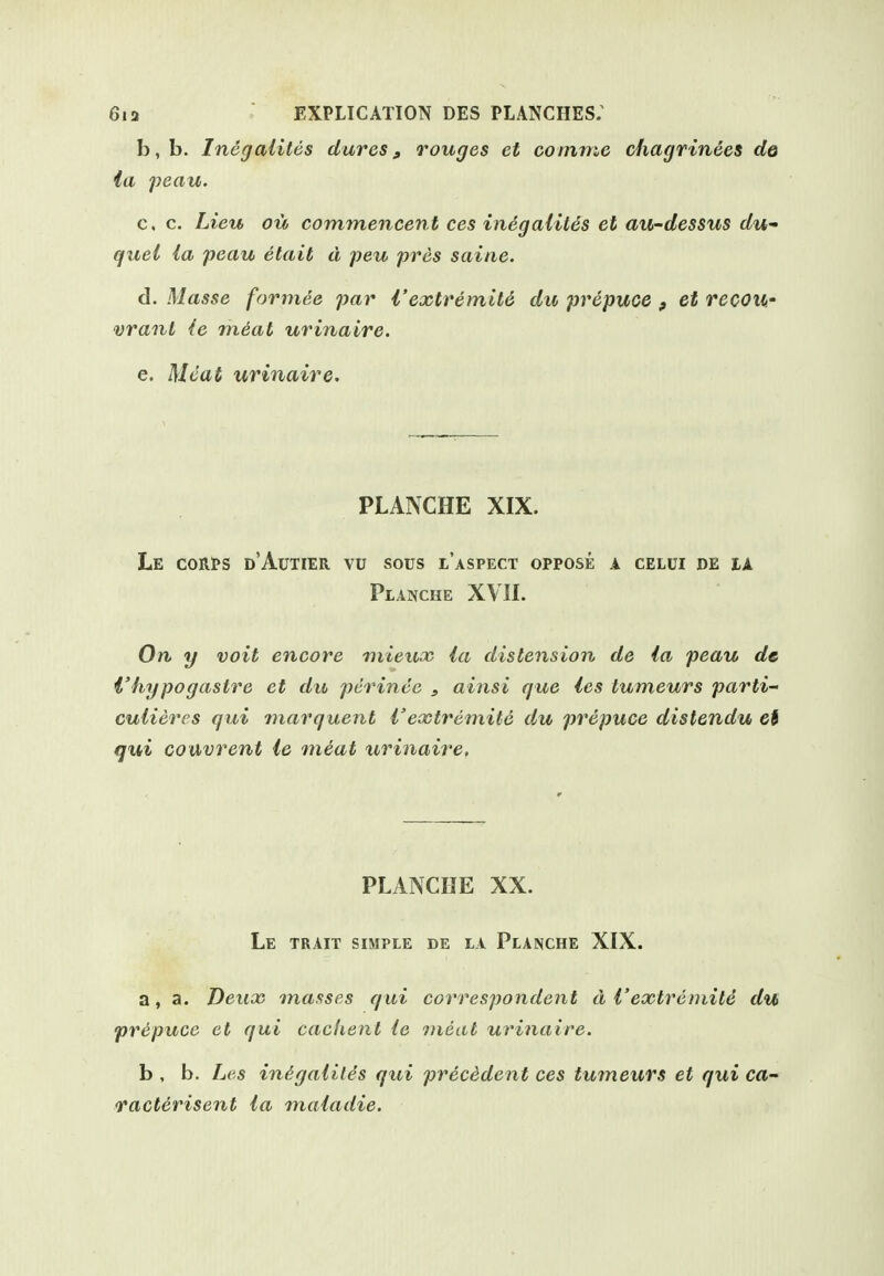 b, b. Inegaiitds dures, rouges et comme chagrined de la peau. c, c. Lieu ou commencent ces inegaliies et au-dessus du- quel la peau etait d peu pros saine. d. Masse formee par I'extremile du prepuce , et recou- want ie meat urinaire. e. Meat urinaire. PLANCHE XIX. Le cori»s d'Autier vu sous l'aspect oppose a celui de IX Planche XVII. On y voit encore mieuno la distension de la peau dc i'hypogastre et du perince , ainsi que les tumeurs parti- cuiieres qui inarquent I'extremite du prepuce distendu ei qui couvrent ie meat urinaire. PLANCHE XX. Le trait simple de la Planche XIX. a, a. Deux masses qui correspondent di'extrcmite du pr&puce et qui caclient ie meal urinaire. b , b. Li'.s inigaliles qui precedent ces tumeurs et qui ca- vacterisent la maladie.