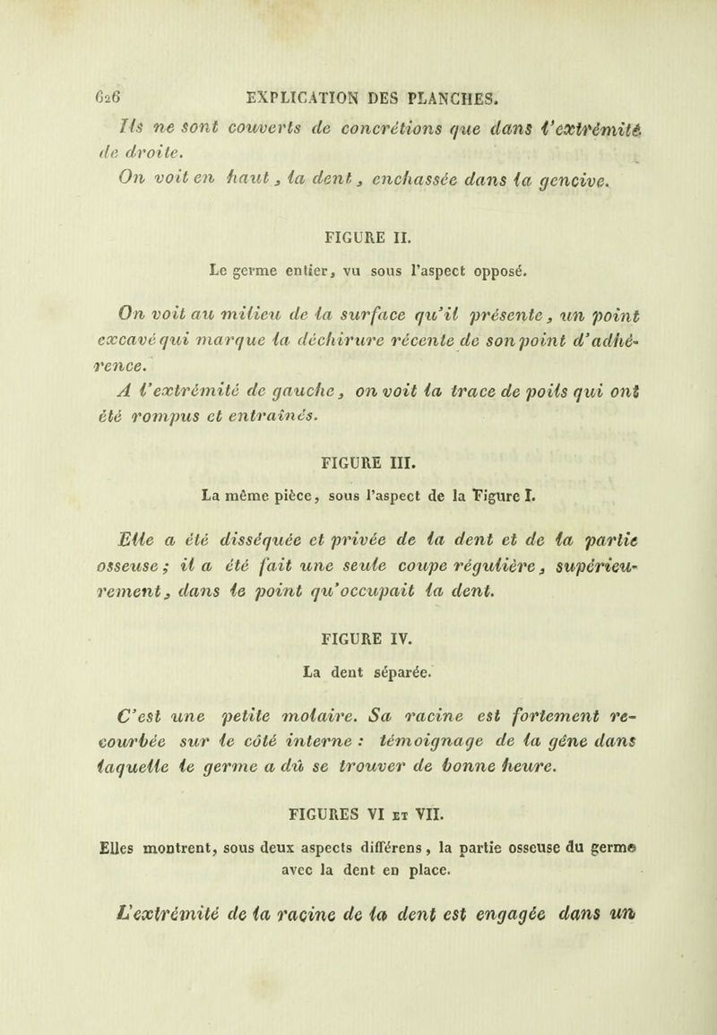 Ih ne sont converts de concretions f/iie dans i'esctfimitif de droile. On voit en haut ^ ia dent, enchassde dans la gencive. FIGURE II. Le germe enlier, vu sous I'aspect oppose. On voit au milieu de la surface qii'ii presente, tm point cxcavequi marque la dechirure reccnte do sonpoint d'adhe- rence. A I'extremite de gauche, on voit la trace de poils qui ont ete rompus ct entraincs. FIGURE nr. La mfime pifece, sous I'aspect de la T'Igure L Bile a ete dissequee et privee de la dent et de la partie osseuse; il a ete fait une seule coupe reguliere ^ supcrieu- rementj dans le point qu occupait la dent. FIGURE IV. La dent separ^e. C'esl xme petite molaire. Sa racine est fortement re- courhee sur le cote interne : temoignage de la gene dans iaquelie le germe a du se trouver de bonne heure. FIGURES VI ET VIL EUes moQtrent, sous deux aspects difl'^rens, la partie osseuse du germe avec la dent en place. Vextremite de ia raoine dc la dent est engag^e dans un