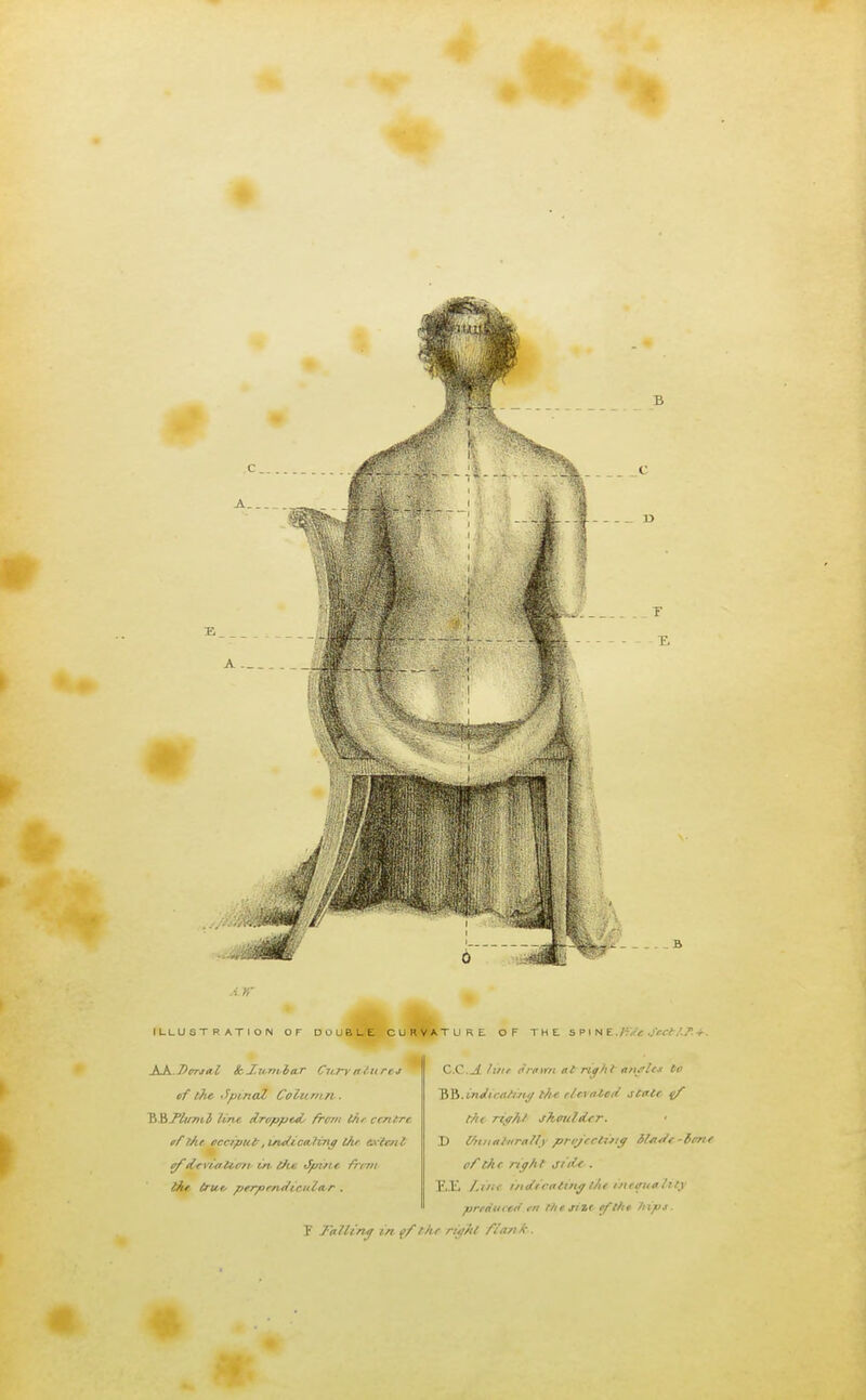 a r,' ILLUSTRATION OF DOUBLE CURVATURE OF THE S PI N E./v> ,/fff.'./r. AA.Dorsal HcXumher Cnryetttrej of the Spinal Column. VtBfliiml line drnpptd, /rem the centre tflAe occiput,melicehno tltr extent efdeviation in. tile Jpme fritn the trut> prrprndr rt'ler . C.C._4 line c'rpiYri at right einflcs to SQ.indicating t/ie elevated Jtete. t//c right shoulder. D Unnaturally projecting Hade -tent of th e ngh t jnie . E,.li Lint indicating t/ie meouality predttccd rn I lie size fifth* /tips, f Jelling in of the rii/At fia/i lr .