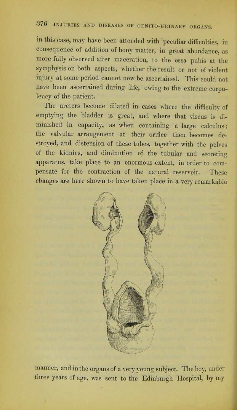 in this case, may have been attended with 'peculiar difficulties, in consequence of addition of bony matter, in great abundance, as more fully observed after maceration, to the ossa pubis at the symphysis on both aspects, whether the result or not of violent injury at some period cannot now be ascertained. This could not have been ascertained during life, owing to the extreme corpu- lency of the patient. The ureters become dilated in cases where the difficulty of emptying the bladder is great, and where that viscus is di- minished in capacity, as when containing a large calculus; the valvular arrangement at their orifice then becomes de- stroyed, and distension of these tubes, together with the pelves of the kidnies, and diminution of the tubular and secreting apparatus, take place to an enormous extent, in order to com- pensate for the contraction of the natural reservoir. These changes are here shown to have taken place in a very remarkable manner, and in the organs of a very young subject. The boy, under three years of age, was sent to the Edinburgh Hospital, by my