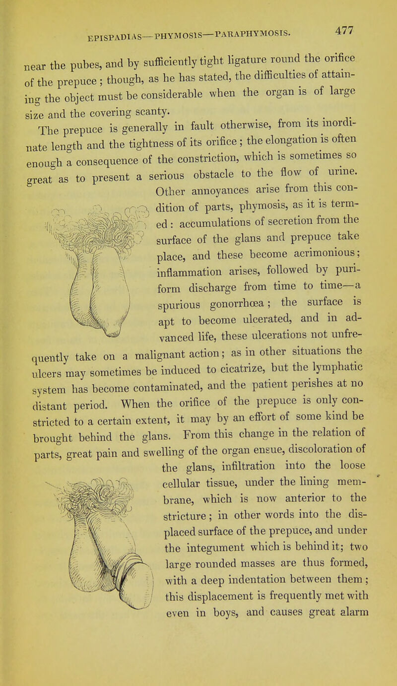 EPISPADIAS—PHYM0S1S PAUAPHYMOSIS. near the pubes, and by sufficiently tight ligature round the orifice of the prepuce ; though, as he has stated, the difficulties of attain- ing the object must be considerable when the organ is of large size and the covering scanty. _ The prepuce is generally in fault otherwise, from its inordi- nate length and the tightness of its orifice ; the elongation is often enouo-h a consequence of the constriction, which is sometimes so creates to present a serious obstacle to the flow of urine. Other annoyances arise from this con- dition of parts, phymosis, as it is term- ed : accumulations of secretion from the surface of the glans and prepuce take place, and these become acrimonious; inflammation arises, followed by puri- form discharge from time to time—a spurious gonorrhoea; the surface is apt to become ulcerated, and in ad- vanced life, these ulcerations not unfre- quently take on a malignant action; as in other situations the ulcers may sometimes be induced to cicatrize, but the lymphatic system has become contaminated, and the patient perishes at no distant period. When the orifice of the prepuce is only con- stricted to a certain extent, it may by an effort of some kind be brought behind the glans. From this change in the relation of parts, great pain and swelling of the organ ensue, discoloration of the glans, infiltration into the loose cellular tissue, under the lining mem- brane, which is now anterior to the stricture; in other words into the dis- placed surface of the prepuce, and under the integument which is behind it; two large rounded masses are thus formed, with a deep indentation between them ; this displacement is frequently met with even in boys, and causes great alarm