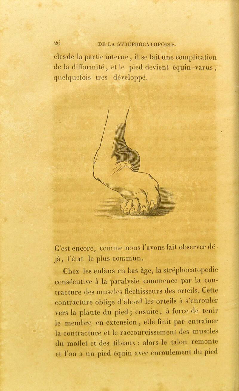 elesde la partie interne, il se fait une complication de la difformité, et le pied devient équin-varus, quelquefois très développé. C'est encore, comme nous l'avons fait observer dé jà, l'état le plus commun. Chez les enfans en bas âge, la stréphocatopodie consécutive à la paralysie commence par la con- tracture des muscles fléchisseurs des orteils. Celle contracture oblige d'abord les orteils à s'enrouler vers la plante du pied; ensuite, à force de tenir le membre en extension , elle finit par entraîner La contracture et le raccourcissement des muscles du mollet et des tibiaux : alors le talon remonte (>i Ton a un pied équiu avec enroulement du pied