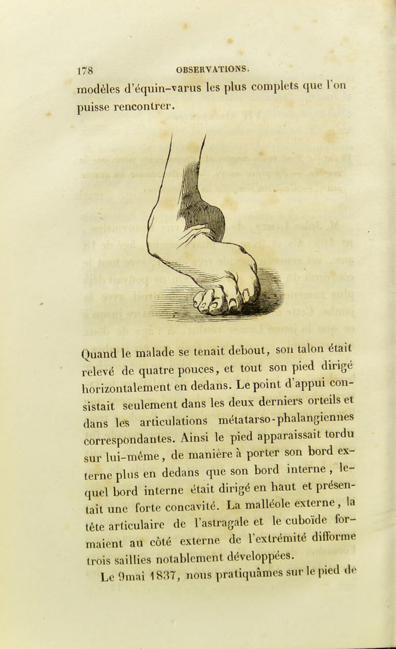 modèles d'équin-varus les plus complets que l'on puisse rencontrer. Quand le malade se tenait debout, son talon était relevé de quatre pouces, et tout son pied dirigé horizontalement en dedans. Le point d'appui con- sistait seulement dans les deux derniers orteils et dans les articulations métatarso-phalangiennes correspondantes. Ainsi le pied apparaissait tordu sur lui-même, de manière à porter son bord ex- terne plus en dedans que son bord interne , le- quel bord interne était dirigé en haut et présen- tait une forte concavité. La malléole externe, la tête articulaire de l'astragale et le cuboïde for- maient au côté externe de l'extrémité difforme trois saillies notablement développées. Le Ornai 1837, nous pratiquâmes sur le pied de