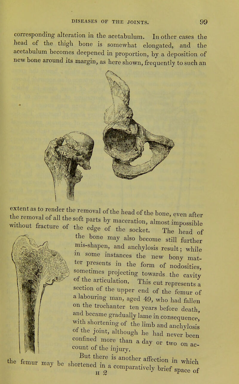 corresponding alteration in the acetabulum. In other cases the head of the thigh bone is somewhat elongated, and the acetabulum becomes deepened in proportion, by a deposition of new bone around its margin, as here shown, frequently to such an extent as to render the removal of the head of the bone even after the bone may also become still further mis-shapen, and anchylosis result; while m some instances the new bony mat- ter presents in the form of nodosities, sometimes projecting towards the cavity of the articulation. This cut represents a section of the upper end of the femur of a labouring man, aged 49, who had fallen on the trochanter ten years before death, and became gradually lame in consequence with shortening of the limb and anchylosis of the jomt, although he had never been confined more than a day or two on ac count of the injury. But there is another affection in .,1.' -l th