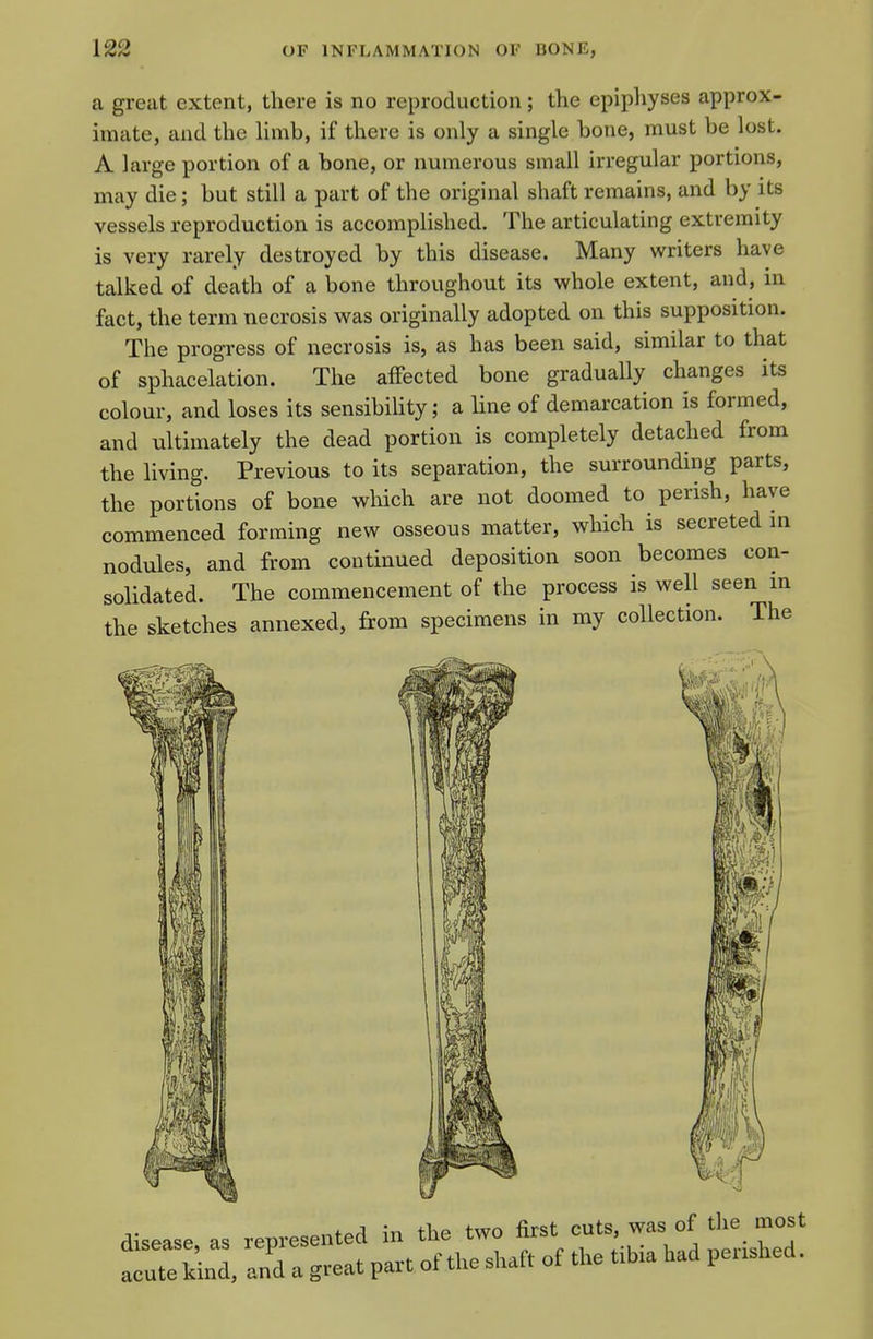 a great extent, there is no reproduction; the epipliyses approx- imate, and the limb, if there is only a single bone, must be lost. A large portion of a bone, or numerous small irregular portions, may die; but still a part of the original shaft remains, and by its vessels reproduction is accomplished. The articulating extremity is very rarely destroyed by this disease. Many writers have talked of death of a bone throughout its whole extent, and, in fact, the term necrosis was originally adopted on this supposition. The progress of necrosis is, as has been said, similar to that of sphacelation. The affected bone gradually changes its colour, and loses its sensibiUty; a Hne of demarcation is formed, and ultimately the dead portion is completely detached from the living. Previous to its separation, the surrounding parts, the portions of bone which are not doomed to perish, have commenced forming new osseous matter, which is secreted in nodules, and from continued deposition soon becomes con- solidated. The commencement of the process is well seen in the sketches annexed, from specimens in my collection. The disease, as represented in the two first cuts, was of the most an' a great part of the shaft of tl>e tib.a had per.shed.