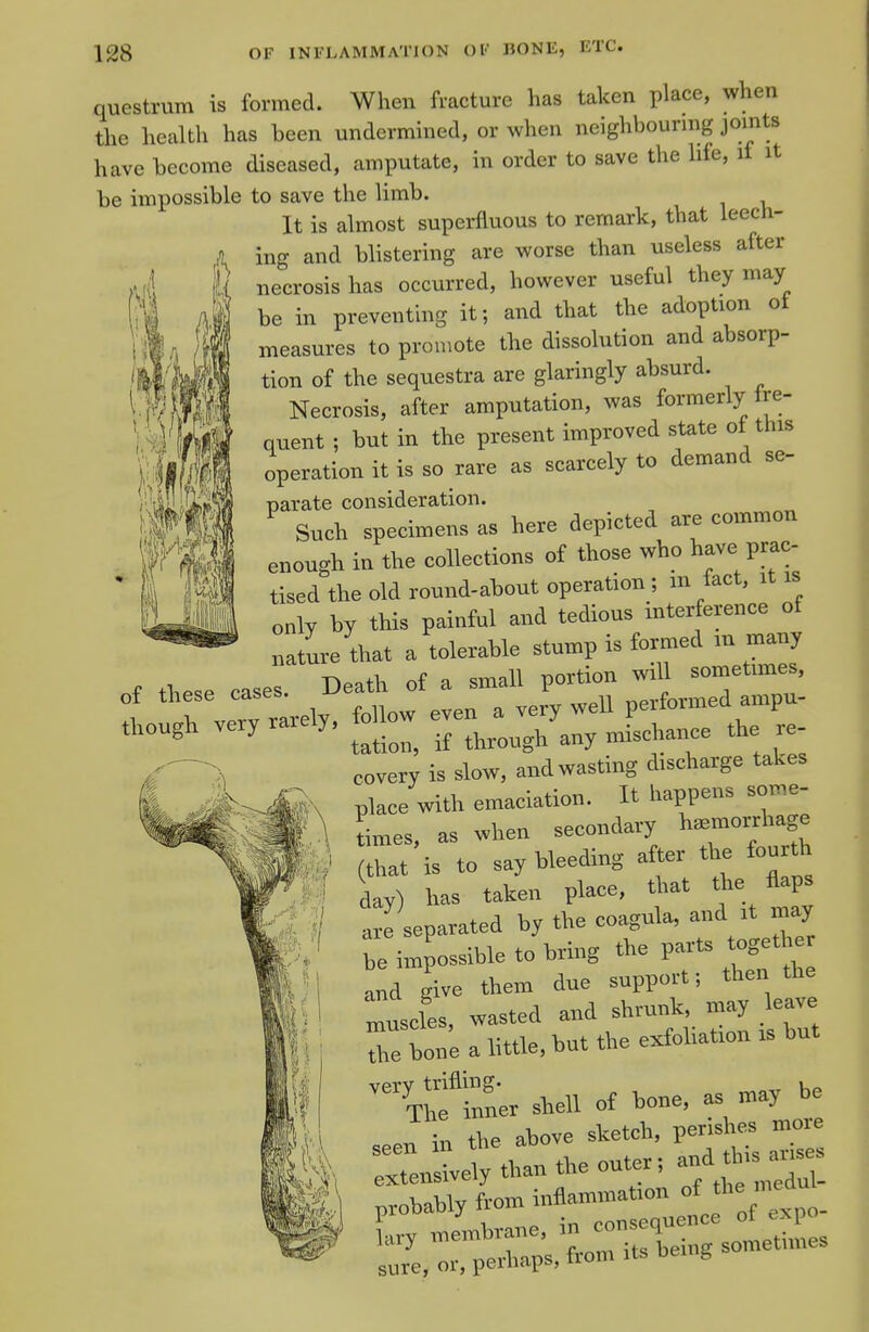 questrum is formed. When fracture has taken place, when the health has been undermined, or when neighbourmg joints have become diseased, amputate, in order to save the life, if it be impossible to save the limb. It is almost superfluous to remark, that leech- ing and blistering are worse than useless after necrosis has occurred, however useful they may be in preventing it; and that the adoption ot measures to promote the dissolution and absorp- tion of the sequestra are glaringly absurd. Necrosis, after amputation, was formerly Ire- quent ; but in the present improved state ot this operation it is so rare as scarcely to demand se- narate consideration. Such specimens as here depicted are common enough in the collections ot those who have prac- tised the old round-about operation ; in fact, it is only by this painful and tedious interference of nature that a tolerable stump is formed in many of these cases. Death of a small P°-^ —^ ,ough very rarely. ^^T:^^::]!^^ the e- covery is slow, and wasting discharge takes place with emaciation. It happens some- times, as when secondary haemorrhage (that is to ^fn*:n, day) has taken place, that the flaps are separated by the copula, and it may be impossible to bring the parts togeth r and give them due support-, then the muscles, wasted and shrunk, may leave Te boe a little, but the exfoliation is but ^%rf fnner shell of bone, as may be in the above sketch, perishes mole rt^nlU ti:antheout.,and*^^^^^^^ P™^^yr-:t—enceof'-po- lary membrane, in sometimes sure, or, perhaps, from its being