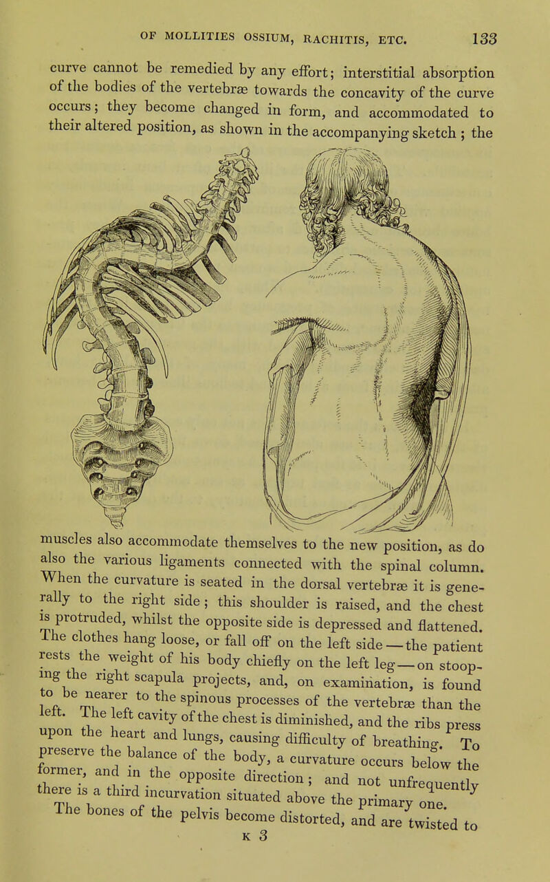 curve cannot be remedied by any effort; interstitial absorption of the bodies of the vertebra towards the concavity of the curve occurs; they become changed in form, and accommodated to their altered position, as shown in the accompanying sketch ; the muscles also accommodate themselves to the new position, as do also the various ligaments connected with the spinal column. When the curvature is seated in the dorsal vertebra it is gene- rally to the right side ; this shoulder is raised, and the chest IS protruded, whilst the opposite side is depressed and flattened. The clothes hang loose, or fall off on the left side-the patient rests the weight of his body chiefly on the left leg-on stoop- ing the right scapula projects, and, on examination, is found to be nearer to the spinous processes of the vertebra than the lelt. The eft cavity of the chest is diminished, and the ribs press upon the heart and lungs, causing difiiculty of breathing. To preserve the balance of the body, a curvature occurs below the former, and in the opposite direction; and not unfrequldv there . a third mcurvation situated above the primary one ' ^ The bones of the pelvis become distorted, and are'^wisL to