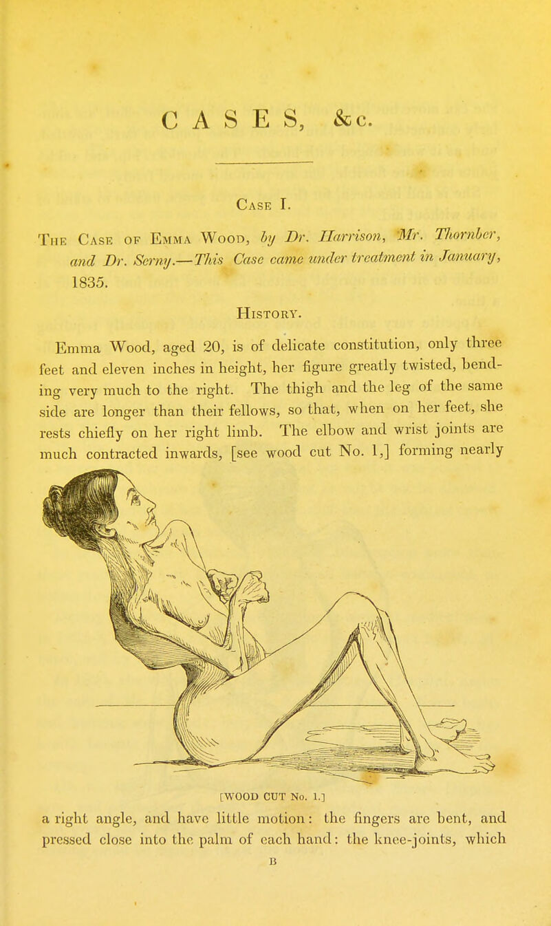 CASES, &c. Case I. The Case of Emma Wood, hy Br. Harrison, Mr, Thornier, and Dr. Serny.—TMs Case came tmder treatment in Janxumj, 1835. History. Emma Wood, aged 20, is of delicate constitution, only three feet and eleven inches in height, her figure greatly twisted, hend- ing very much to the right. The thigh and the leg of the same side are longer than their fellows, so that, when on her feet, she rests chiefly on her right limb. The elbow and wrist joints are much contracted inwards, [see wood cut No. 1,] forming nearly [WOOD CUT No. 1.] a right angle, and have little motion: the fingers are bent, and pressed close into the palm of each hand: the knee-joints, which