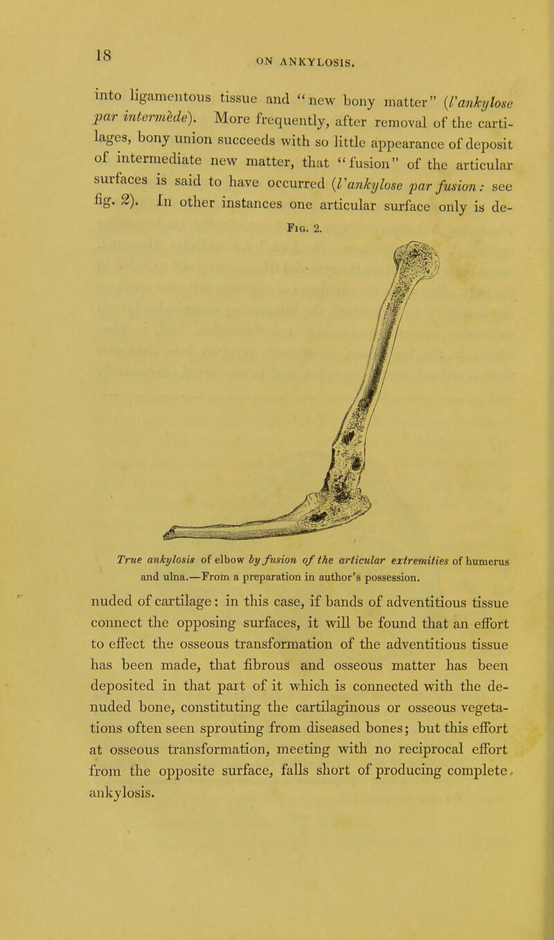 ON ANKYLOSIS. into ligcamentous tissue and new bony matter {rankylose par intermede). More frequently, after removal of the carti- lages, bony union succeeds with so little appearance of deposit of intermediate new matter, that ''fusion of the articular surfaces is said to have occurred {Vankylose par fusion: see fig. 2). In other instances one articular siirface only is de- FiG. 2. True ankylosis of elhow by fusion of the articular extremities of \mvaems and ulna.—From a preparation in author's possession. nuded of cartilage: in this case, if bands of adventitious tissue connect the opposing surfaces, it vdll be found that an eifort to effect the osseous transformation of the adventitious tissue has been made, that fibrous and osseous matter has been deposited in that part of it which is connected with the de- nuded bone, constituting the cartilaginous or osseous vegeta- tions often seen sprouting from diseased bones; but this effort at osseous transformation, meeting with no reciprocal effort from the opposite surface, falls short of producing complete. ankylosis.