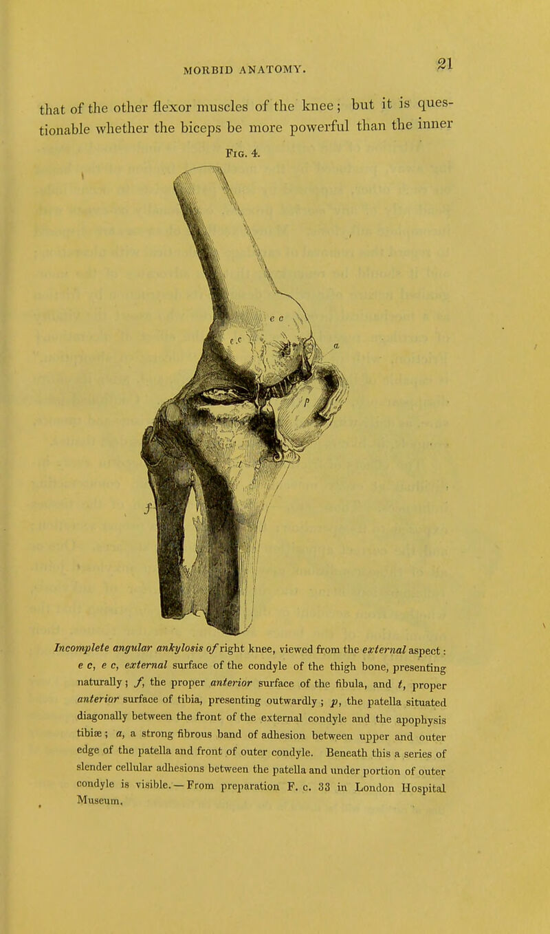 ^1 that of the other flexor muscles of the knee ; but it is ques- tionable whether the biceps be more powerful than the inner Fig. 4. Incomplete angular ankylosis 0/right knee, viewed from the external aspect: e c, e c, external surface of the condyle of the thigh bone, presenting naturally; /, the proper anterior surface of the fibula, and t, proper anterior surface of tibia, presenting outwardly ; p, the patella situated diagonally between the front of the external condyle and the apophysis tibifE; a, a strong fibrous band of adhesion between upper and outer edge of the patella and front of outer condyle. Beneath this a series of slender cellular adhesions between the pateUa and under portion of outer condyle is visible. — From preparation F. c. 33 in London Hospital Museum.