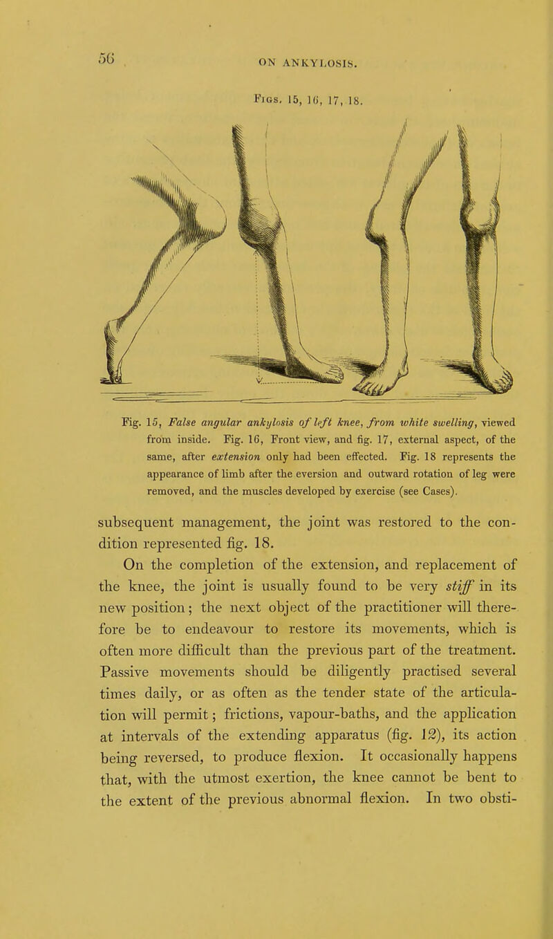 Figs, 15, Hi, 17, 18. Fig. 15, False angular ankylosis of left knee, from white swelling, viewed from inside. Fig. 16, Front view, and fig. 17, external aspect, of the same, after extension only had been effected. Fig. 18 represents the appearance of limb after the eversion and outward rotation of leg were removed, and the muscles developed by exercise (see Cases). subsequent management, the joint was restored to the con- dition represented fig. 18. On the completion of the extension, and replacement of the knee, the joint is usually found to be very stiff in its new position ; the next object of the practitioner will there- fore be to endeavour to restore its movements, which is often more difficult than the previous part of the treatment. Passive movements should be diligently practised several times daily, or as often as the tender state of the articula- tion wdll permit; frictions, vapour-baths, and the application at intervals of the extending apparatus (fig. 12), its action being reversed, to produce flexion. It occasionally happens that, with the utmost exertion, the knee cannot be bent to the extent of the previous abnormal flexion. In two obsti-