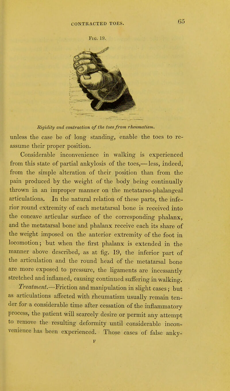 Rigidity and contraction of the toes from rheumatism. unless the case be of long standing, enable the toes to re- assume their proper position. Considerable inconvenience in walking is experienced from this state of partial ankylosis of the toes,—less, indeed, from the simple alteration of their position than from the pain produced by the weight of the body being continually thrown in an improper manner on the metatarso-phalangeal articulations. In the natural relation of these parts, the infe- rior round extremity of each metatarsal bone is received into the concave articular surface of the corresponding phalanx, and the metatarsal bone and phalanx receive each its share of the weight imposed on the anterior extremity of the foot in locomotion; but when the first phalanx is extended in the mamier above described, as at fig. 19, the inferior part of the articulation and the round head of the metatarsal bone are more exposed to pressure, the ligaments are incessantly stretched and inflamed, causing continued suffering in walking. Treatment.—Friction and manipulation in slight cases ; but as articulations affected with rheumatism usually remain ten- der for a considerable time after cessation of the inflammatory process, the patient will scarcely desire or permit any attempt to remove the resulting deformity until considerable incon- venience has been experienced. Those cases of false anky- F