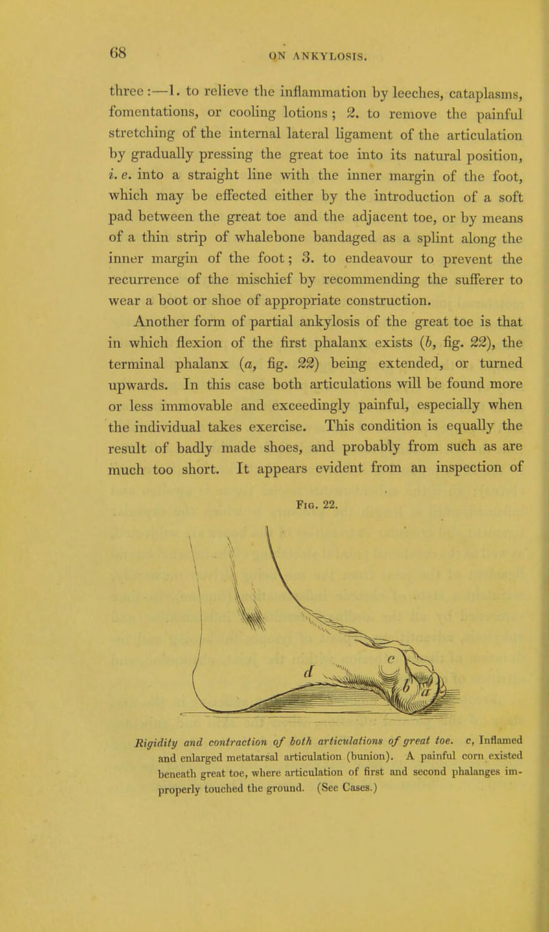 three :—1. to relieve the inflammation by leeches, cataplasms, fomentations, or cooling lotions ; 2. to remove the painful stretching of the internal lateral ligament of the articulation by gradually pressing the great toe into its natural position, i. e. into a straight line with the inner margin of the foot, which may be effected either by the introduction of a soft pad between the great toe and the adjacent toe, or by means of a thin strip of whalebone bandaged as a splint along the inner margin of the foot; 3. to endeavour to prevent the recurrence of the mischief by recommending the sufferer to wear a boot or shoe of appropriate construction. Another form of partial ankylosis of the great toe is that in which flexion of the first phalanx exists {h, fig. 22), the terminal phalanx {a, fig. 22) being extended, or turned upwards. In this case both articulations will be found more or less immovable and exceedingly painful, especially when the individual takes exercise. This condition is equally the result of badly made shoes, and probably from such as are much too short. It appears evident from an inspection of Fig. 22. Rigidity and contraction of loth articulations of great toe. c, Inflamed and enlarged metatarsal articulation (bunion). A painful corn e.xisted beneath great toe, where articulation of first and second phalanges im- properly touched the ground. (See Cases.)