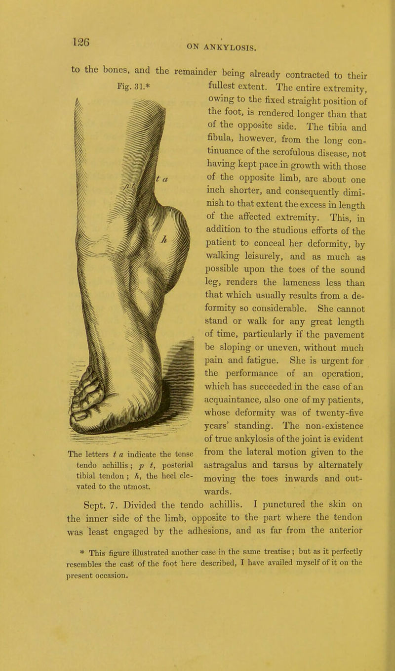 ON ANKYLOSIS. to the bones, and the remamder being already contracted to their Kg- 31.* fullest extent. The entire extremity, owing to the fixed straight position of the foot, is rendered longer than that of the opposite side. The tibia and fibula, however, from the long con- tinuance of the scrofulous disease, not having kept pace in growth with those of the opposite limb, are about one inch shorter, and consequently dimi- nish to that extent the excess in length of the aflfected extremity. This, in addition to the studious efibrts of the patient to conceal her deformity, by walking leisurely, and as much as possible upon the toes of the sound leg, renders the lameness less than that which usually results from a de- formity so considerable. She cannot stand or walk for any great length of time, particularly if the pavement be sloping or uneven, without much pain and fatigue. She is urgent for the performance of an operation, which has succeeded in the case of an acquaintance, also one of my patients, whose deformity was of twenty-five years' standing. The non-existence of true ankylosis of the joint is evident from the lateral motion given to the astragalus and tarsus by alternately moving the toes inwards and out- wards. Sept. 7. Divided the tendo achdlis. I punctured the skin on the inner side of the limb, opposite to the part where the tendon was least engaged by the adhesions, and as far from the anterior * This figure illustrated another case in the same treatise; but as it perfectly resembles the cast of the foot here described, I have availed myself of it on the present occasion. The letters t a indicate the tense tendo achillis; p t, posterial tibial tendon ; h, the heel ele- vated to the utmost.