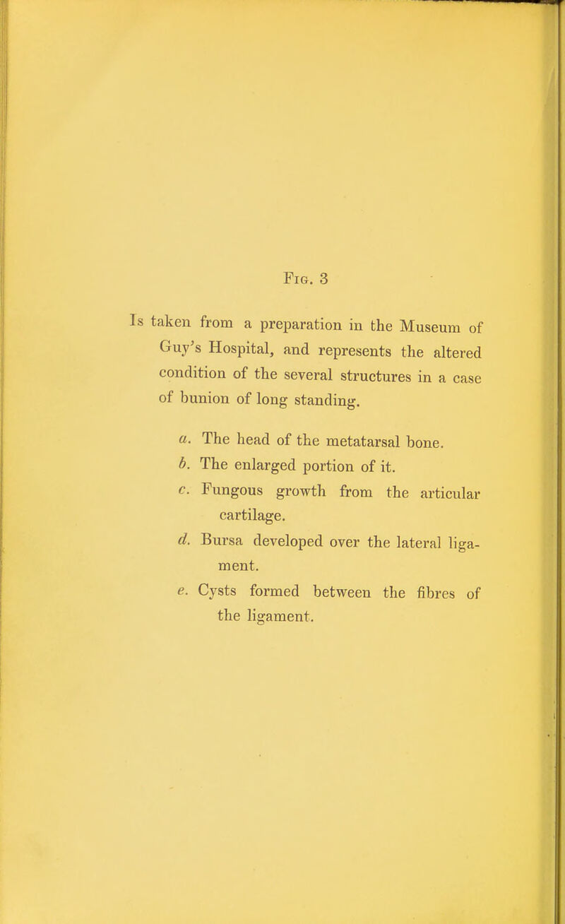 Is taken from a preparation in the Museum of Guy's Hospital, and represents the altered condition of the several structures in a case of bunion of long standing. a. The head of the metatarsal bone. b. The enlarged portion of it. c. Fungous growth from the articular cartilage. d. Bursa developed over the lateral liga- ment. e. Cysts formed between the fibres of the ligament.