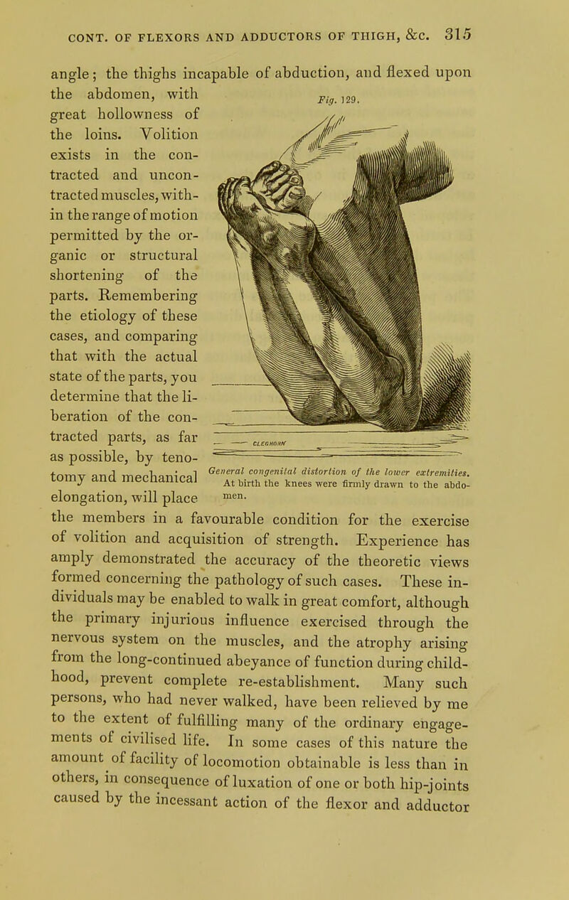 angle ; the thighs incapable of abduction, and flexed upon Fig. 129. the abdomen, with great hollowness of the loins. Volition exists in the con- tracted and uncon- tracted muscles, with- in the range of motion permitted by the or- ganic or structural shortening of the parts. Remembering the etiology of these cases, and comparing that with the actual state of the parts, you determine that the li- beration of the con- tracted parts, as far as possible, by teno- tomy and mechanical elongation, will place the members in a favourable condition for the exercise of volition and acquisition of strength. Experience has amply demonstrated the accuracy of the theoretic views formed concerning the pathology of such cases. These in- dividuals may be enabled to walk in great comfort, although the primary injurious influence exercised through the nervous system on the muscles, and the atrophy arising from the long-continued abeyance of function during child- hood, prevent complete re-establishment. Many such persons, who had never walked, have been relieved by me to the extent of fulfilling many of the ordinary engage- ments of civilised life. In some cases of this nature the amount of facility of locomotion obtainable is less than in others, in consequence of luxation of one or both hip-joints caused by the incessant action of the flexor and adductor General congenital distortion of the lower extremities. At birth the knees were firmly drawn to the abdo- men.