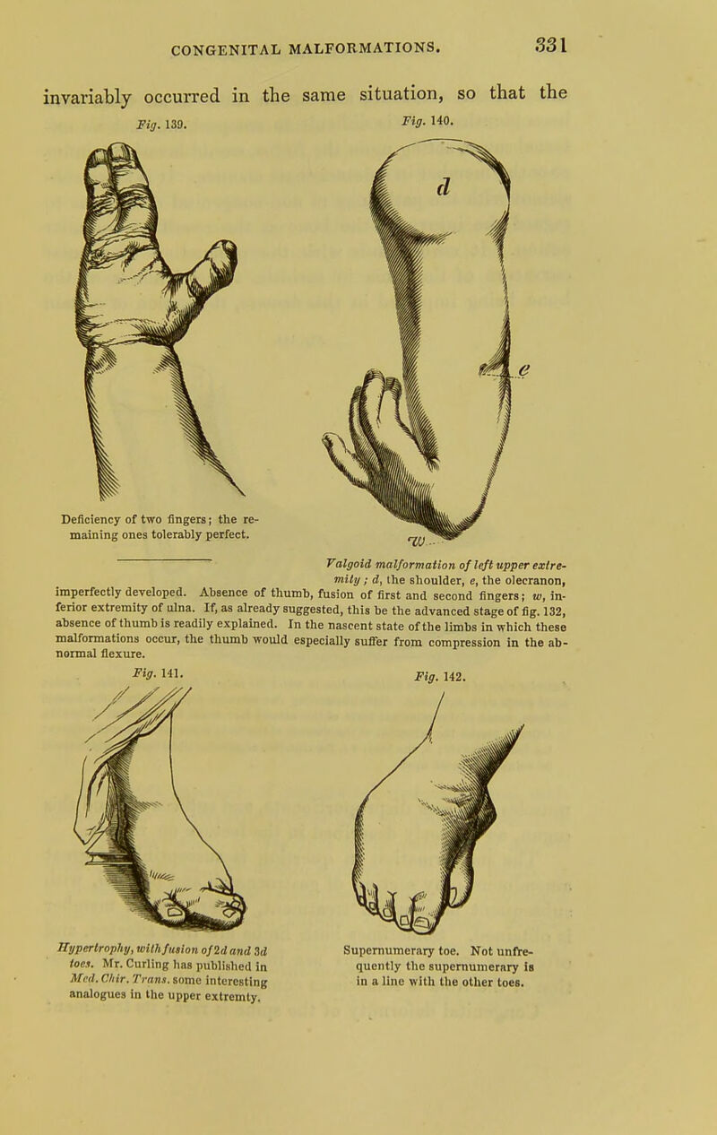 invariably occurred in the same situation, so that the Fig. 139. Tig- 140. Valgoid malformation of left upper extre- mity ; d, ihe shoulder, e, the olecranon, imperfectly developed. Absence of thumb, fusion of first and second fingers; u>, in- ferior extremity of ulna. If, as already suggested, this be the advanced stage of fig. 132, absence of thumb is readily explained. In the nascent state of the limbs in which these malformations occur, the thumb would especially suffer from compression in the ab- normal flexure. Fig. HI. Fig, 142. Hypertrophy, with fusion of 2d and 3d Supernumerary toe. Not unfre- tocs. Mr. Curling has published in quently the supernumerary is Med. C.hir. Tram, some interesting in a line with the other toes, analogues in the upper extremty.