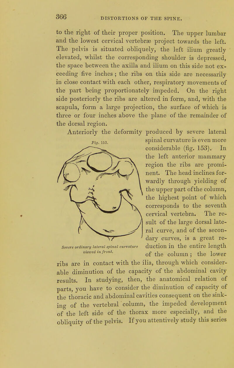 to the right of their proper position. The upper lumhar and the lowest cervical vertebrae project towards the left. The pelvis is situated obliquely, the left ilium greatly elevated, whilst the corresponding shoulder is depressed, the space between the axilla and ilium on this side not ex- ceeding five inches ; the ribs on this side are necessarily in close contact with each other, respiratory movements of the part being proportionately impeded. On the right side posteriorly the ribs are altered in form, and, with the scapula, form a large projection, the surface of which is three or four inches above the plane of the remainder of the dorsal region. Anteriorly the deformity produced by severe lateral ■p. 153 spinal curvature is even more considerable (fig. 153). In the left anterior mammary region the ribs are promi- nent. The head inclines for- wardly through yielding of the upper part of the column, the highest point of which corresponds to the seventh cervical vertebra. The re- sult of the large dorsal late- ral curve, and of the secon- dary curves, is a great re- duction in the entire length of the column ; the lower ribs are in contact with the ilia, through which consider- able diminution of the capacity of the abdominal cavity results. In studying, then, the anatomical relation of parts, you have to consider the diminution of capacity of the thoracic and abdominal cavities consequent on the sink- ing of the vertebral column, the impeded development of the left side of the thorax more especially, and the obliquity of the pelvis. If you attentively study this series Severe ordinary lateral spinal curvature viewed in front.