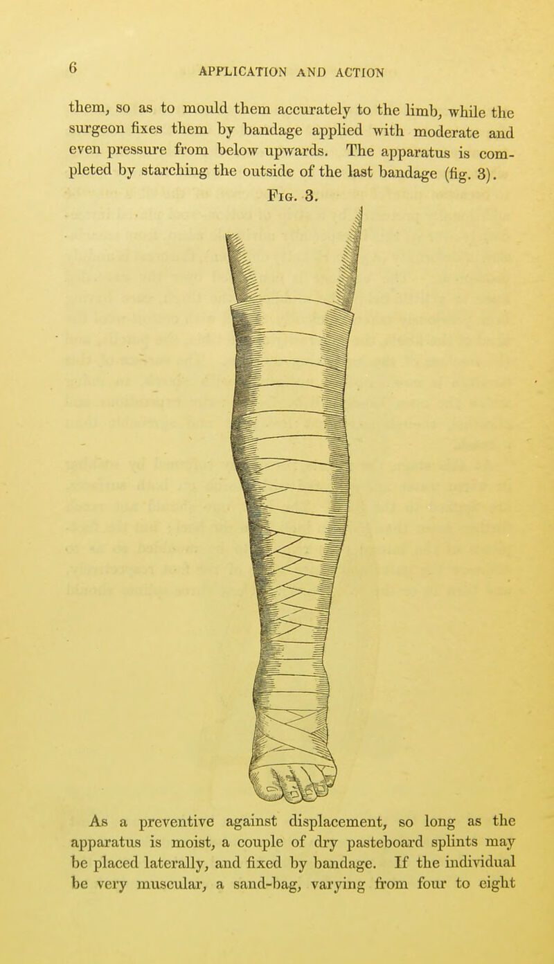 them, so as to mould them accurately to the limb, while the surgeon fixes them by bandage applied with moderate and even pressure from below upwards. The apparatus is com- pleted by starching the outside of the last bandage (fig. 3). Fig. 3. As a preventive against displacement, so long as the apparatus is moist, a couple of dry pasteboard splints may be placed laterally, and fixed by bandage. If the individual be very muscular, a sand-bag, varying from four to eight