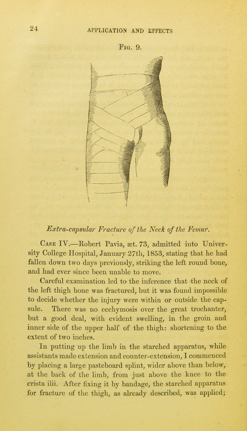 Fig. 9. Extra-capsular Fracture of the Neck of the Femur. Case IV.—Robert Pavia, set. 73, admitted into Univer- sity College Hospital, January 27th, 1853, stating that he had fallen down two days previously, striking the left round bone, and had ever since been unable to move. Careful examination led to the inference that the neck of the left thigh bone was fractured, but it was found impossible to decide whether the injury were within or outside the cap- sule. There was no ecchymosis over the great trochanter, but a good deal, with evident swelling, in the groin and inner side of the upper half of the thigh: shortening to the extent of two inches. In putting up the limb in the starched apparatus, while assistants made extension and counter-extension, I commenced by placing a large pasteboard splint, wider above than below, at the back of the limb, from just above the knee to the crista ilii. After fixing it by bandage, the starched apparatus for fracture of the thigh, as already described, was applied;