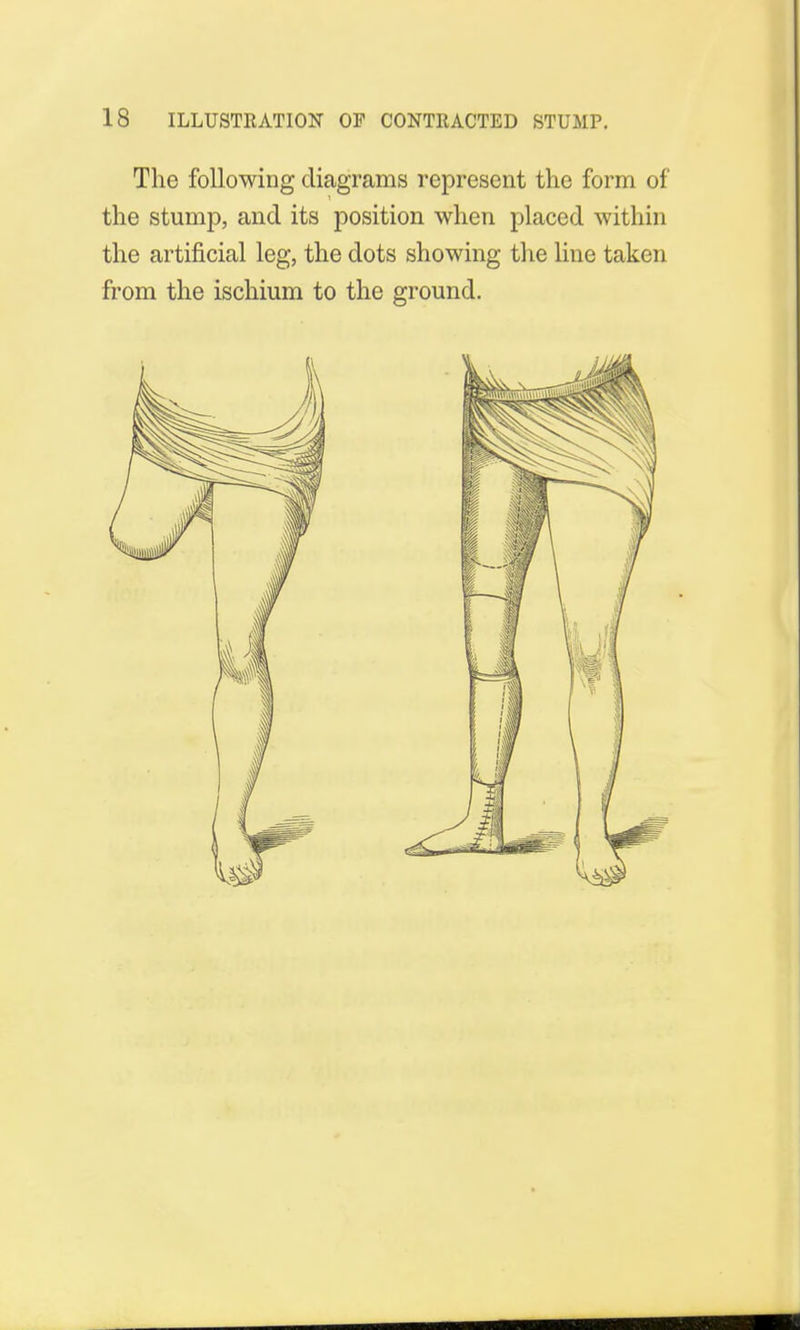 The following diagrams represent the form of the stump, and its position when placed within the artificial leg, the dots showing the line taken from the ischium to the ground.
